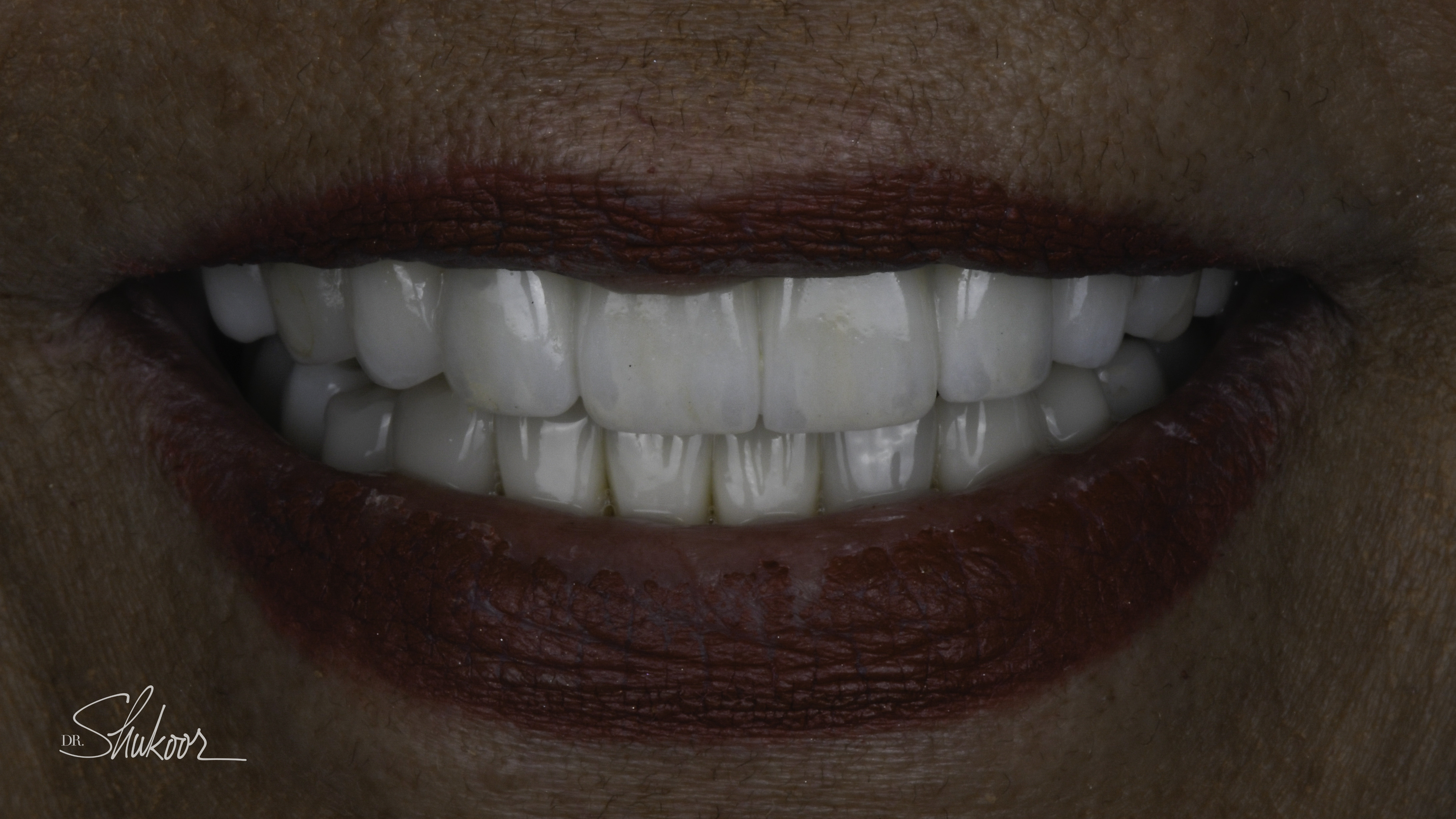 Smile makeover before and after — Worn, mismatched restorations rebuilt in a full-mouth rehabilitation, treated by Dr. Kambez Shukoor in Washington, DC — after treatment
