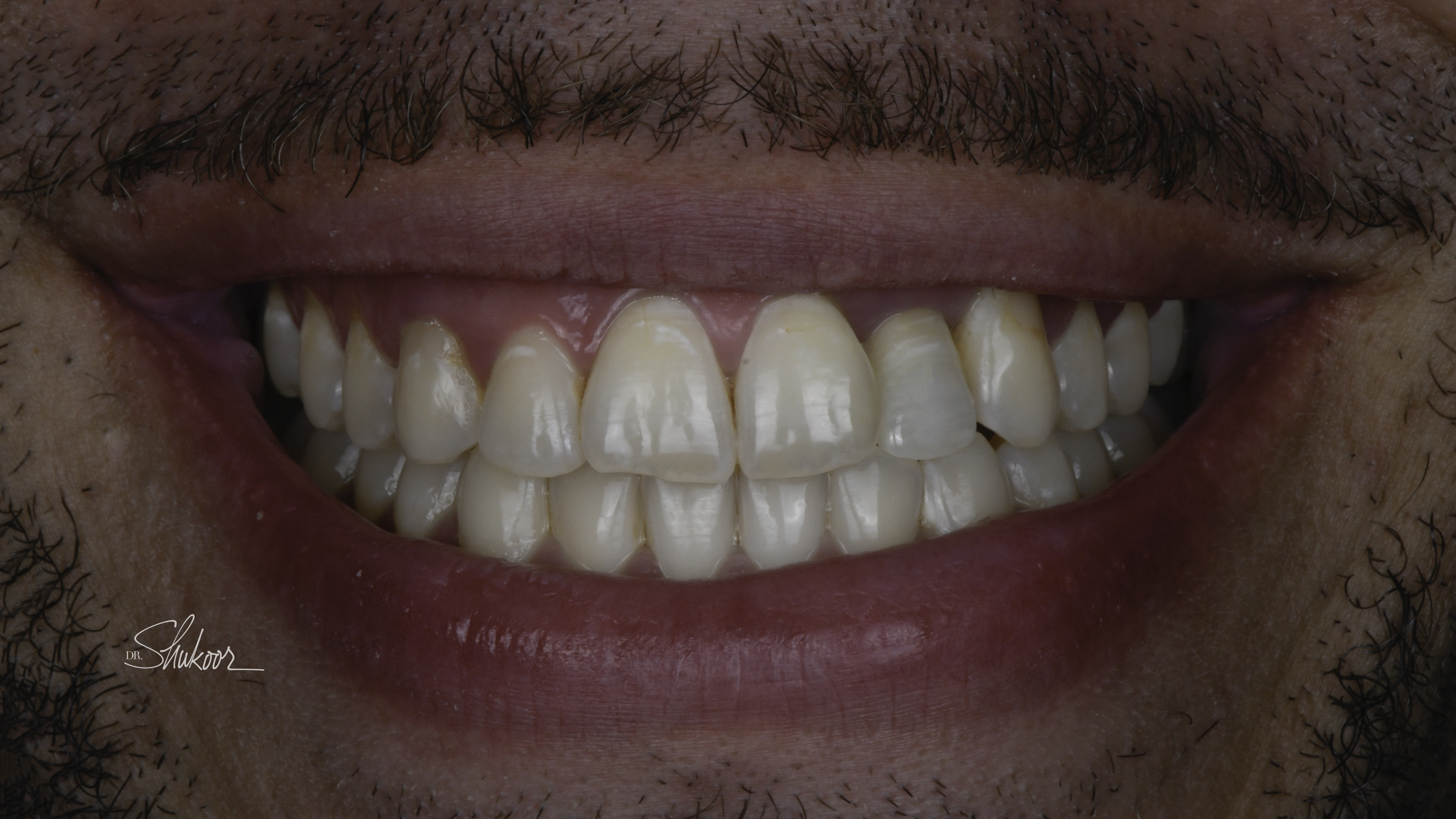 Clear aligners before and after, close-up view — Crowded arch expanded and leveled with clear aligners, treated by Dr. Kambez Shukoor in Washington, DC — after treatment