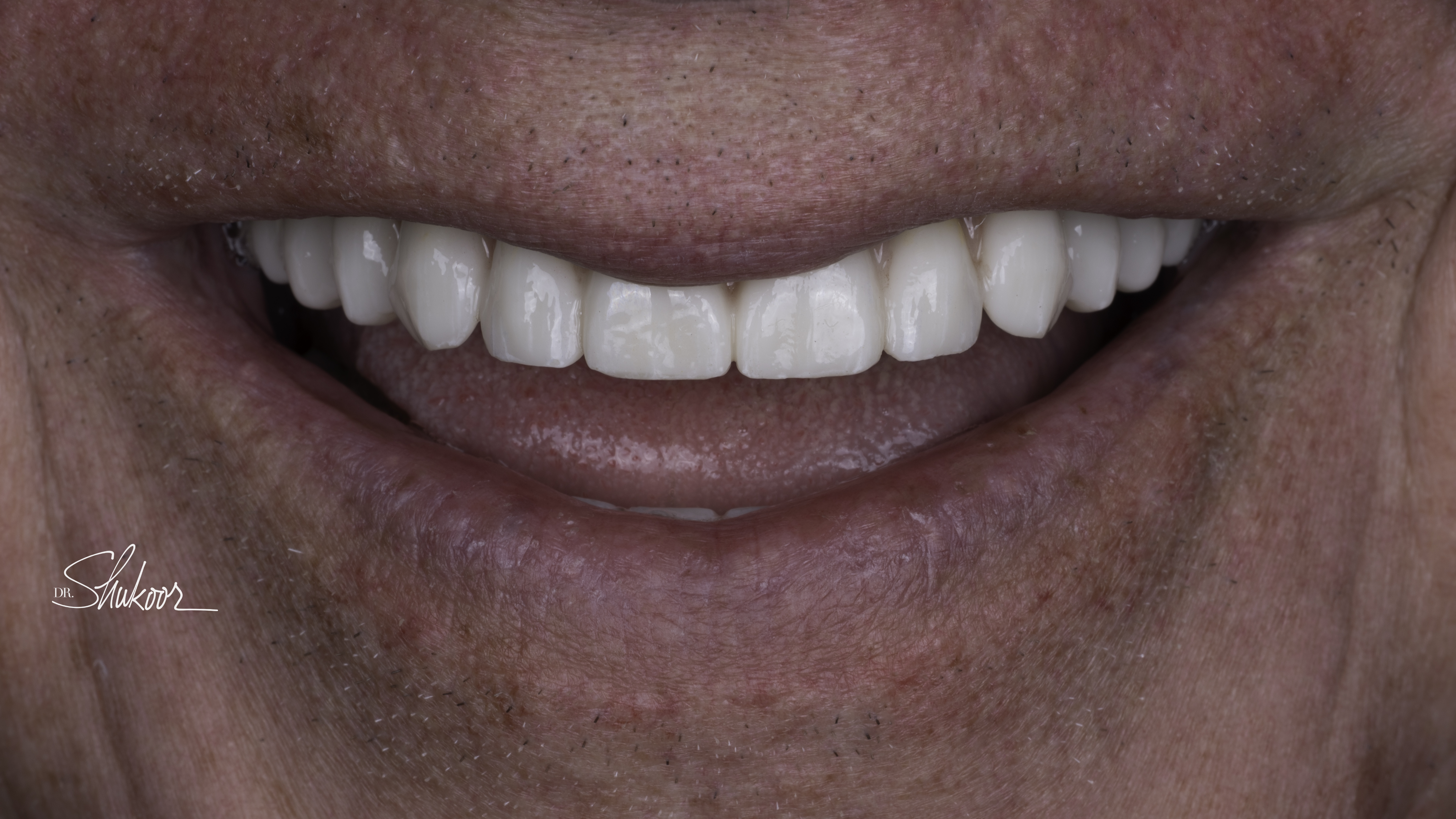Smile view — Full-arch implant before and after, Advanced periodontal breakdown treated with full-arch implants, Washington, DC — after treatment