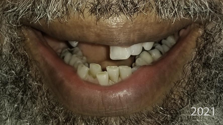 Close-up view — Full-arch implant before and after, Broken-down teeth rebuilt with full-arch implant restoration, Washington, DC — before treatment
