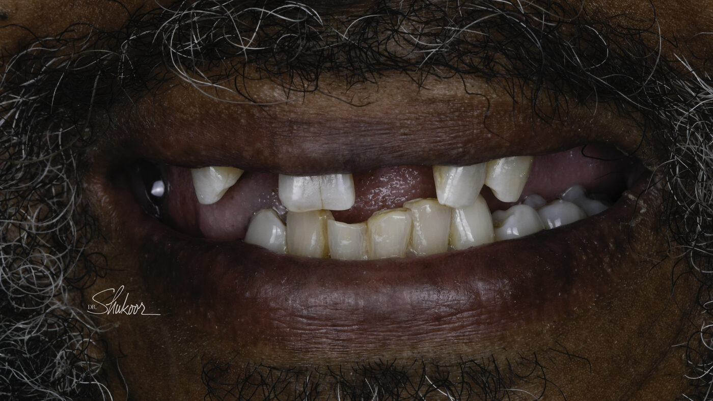 Dental Flipper case — Missing front tooth replaced immediately with a dental flipper, treated by Dr. Kambez Shukoor in Washington, DC — before treatment