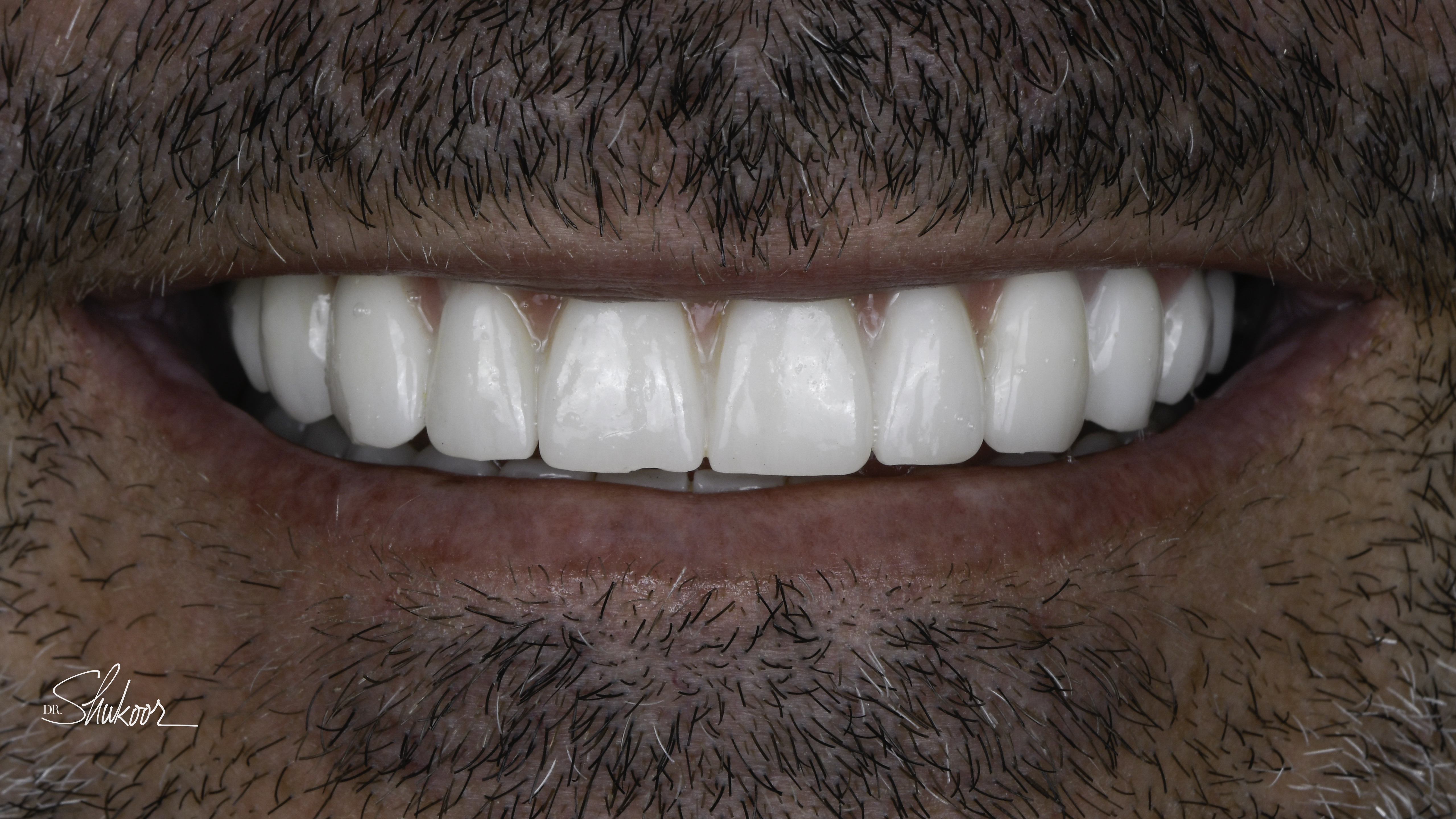 Close-up view — Full-arch implant before and after, Worn, discolored dentition restored with full-arch implants, Washington, DC — after treatment