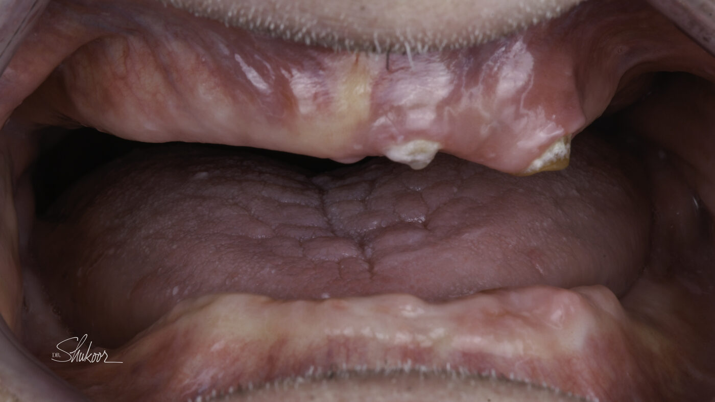 Dentures case — Full dentures restore a complete smile and comfortable bite, treated by Dr. Kambez Shukoor in Washington, DC — before treatment