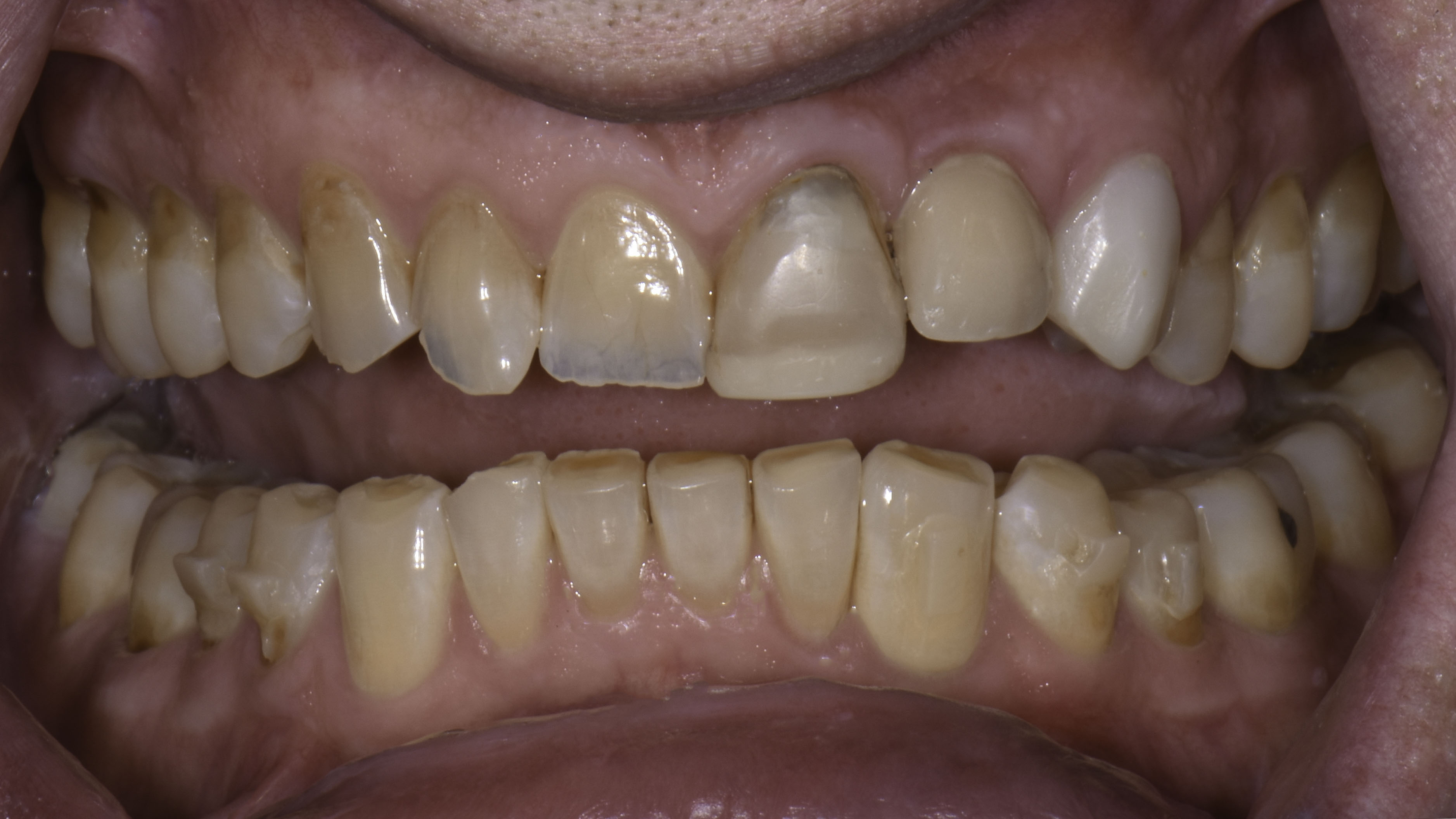 Retracted view — Smile makeover before and after, Damaged and discolored teeth renewed with full-mouth rehabilitation, Washington, DC — before treatment