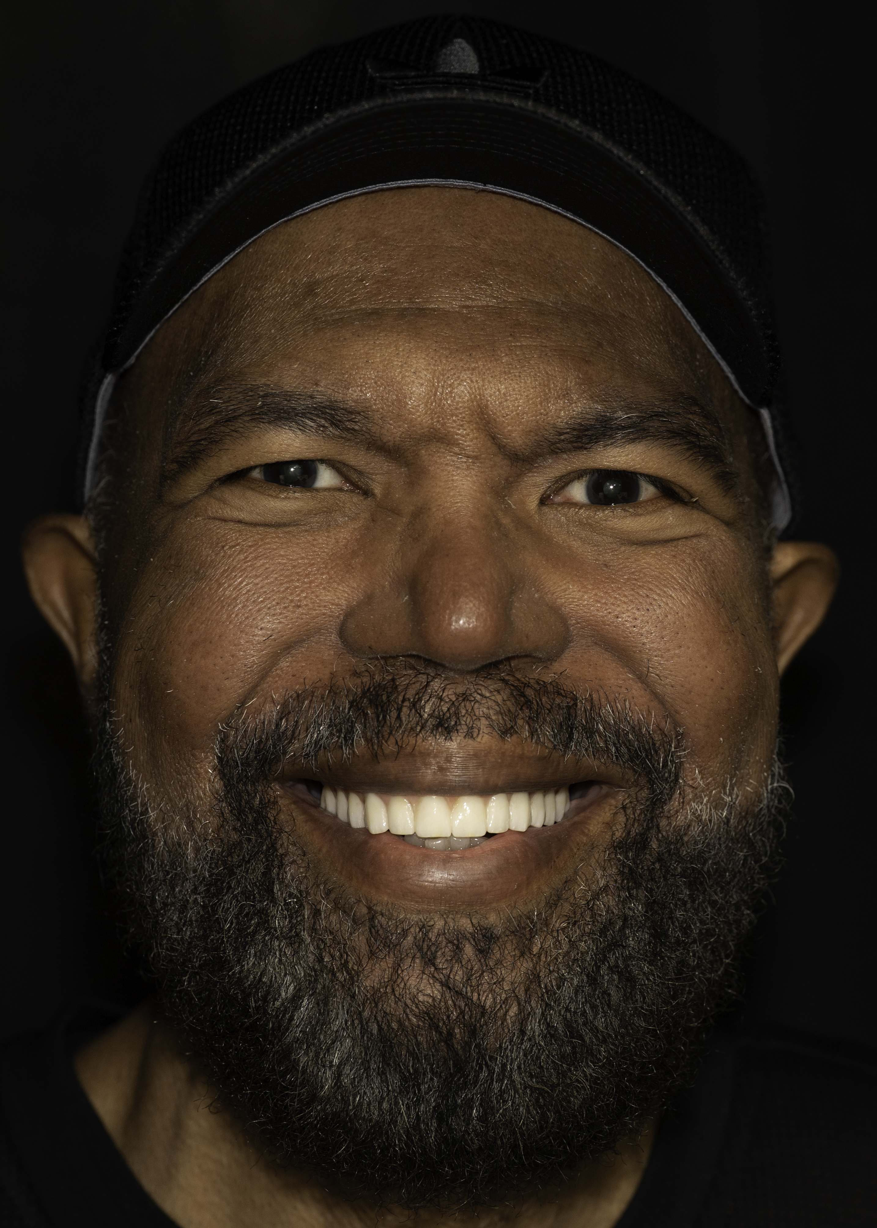 Full-arch implant before and after — Broken-down teeth rebuilt with full-arch implant restoration, treated by Dr. Kambez Shukoor in Washington, DC — after treatment