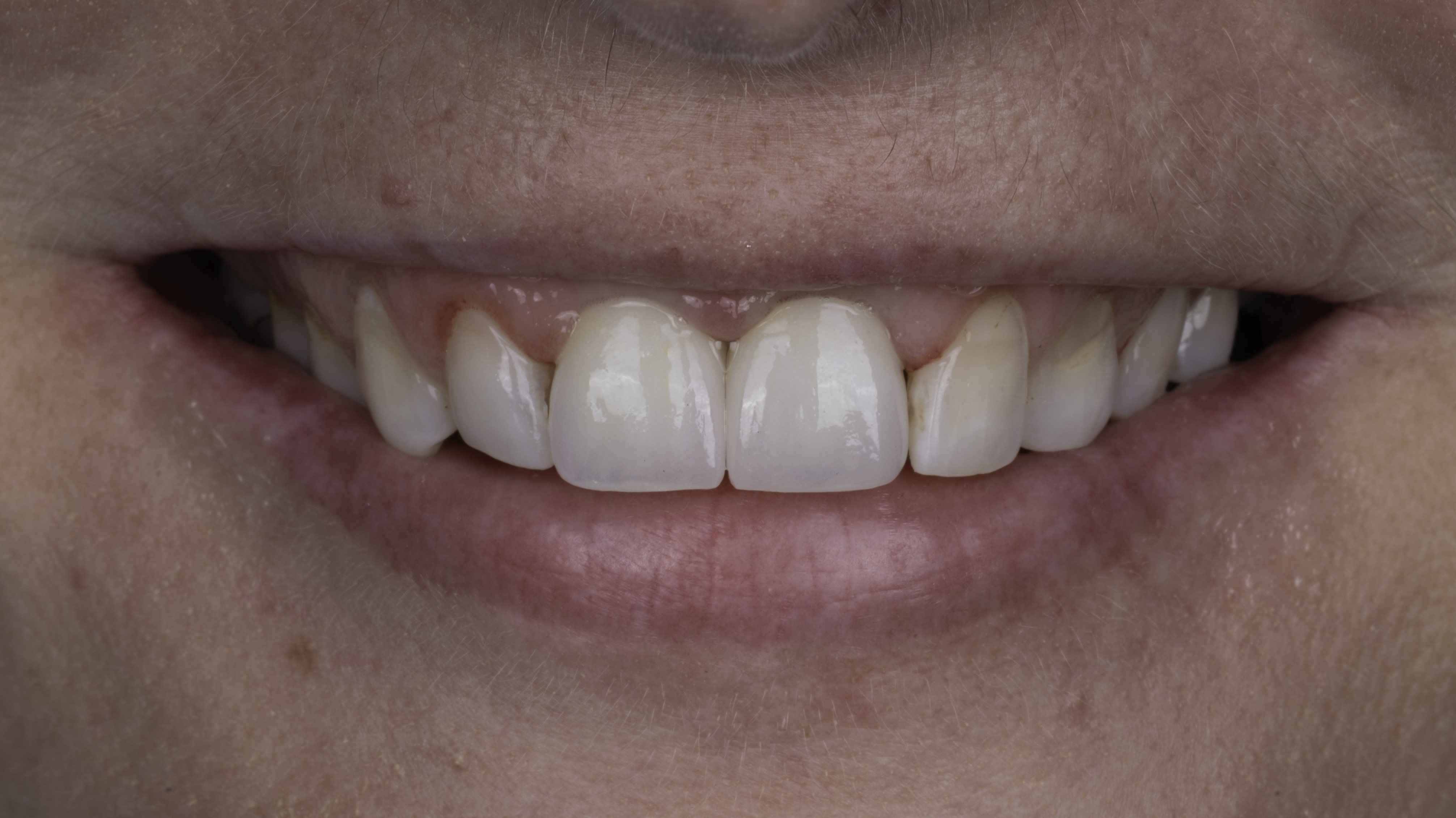 Full-arch implant before and after — Dark, aging front crowns renewed with implant restorations, treated by Dr. Kambez Shukoor in Washington, DC — after treatment