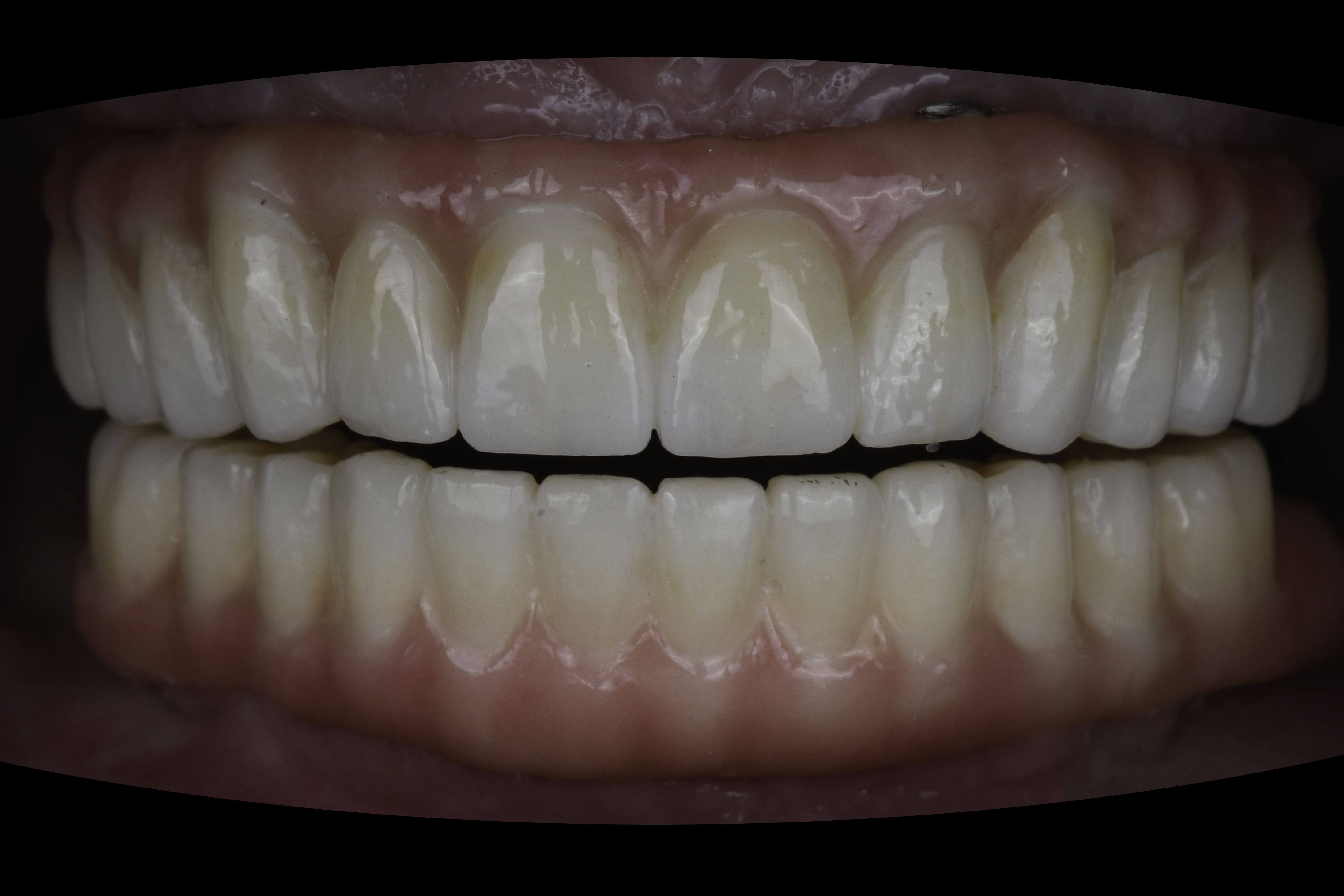 Retracted view — Full-arch implant before and after, Complete upper and lower reconstruction on dental implants, Washington, DC — after treatment