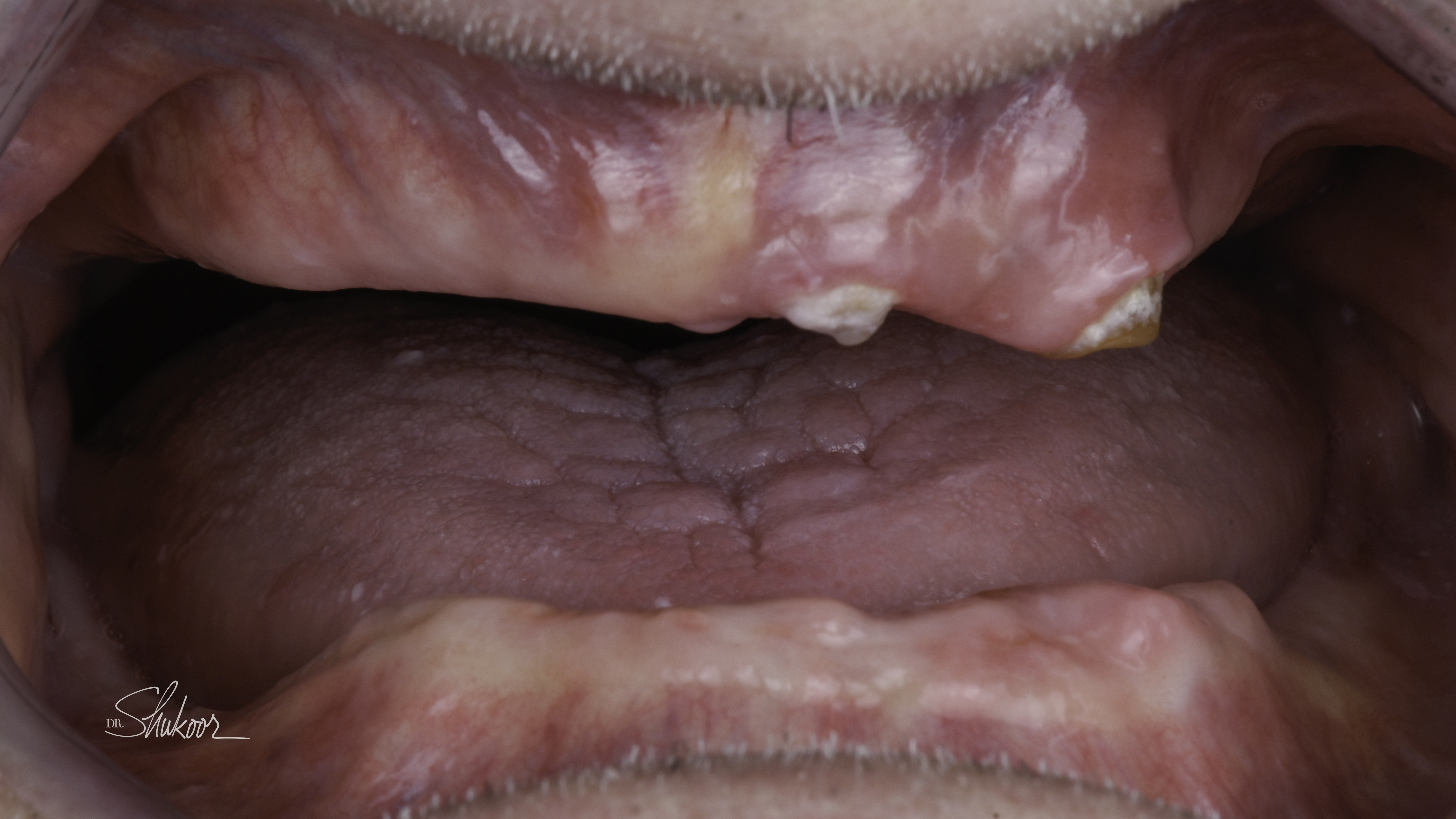 Dentures case, close-up view — Full dentures restore a complete smile and comfortable bite, treated by Dr. Kambez Shukoor in Washington, DC — before treatment