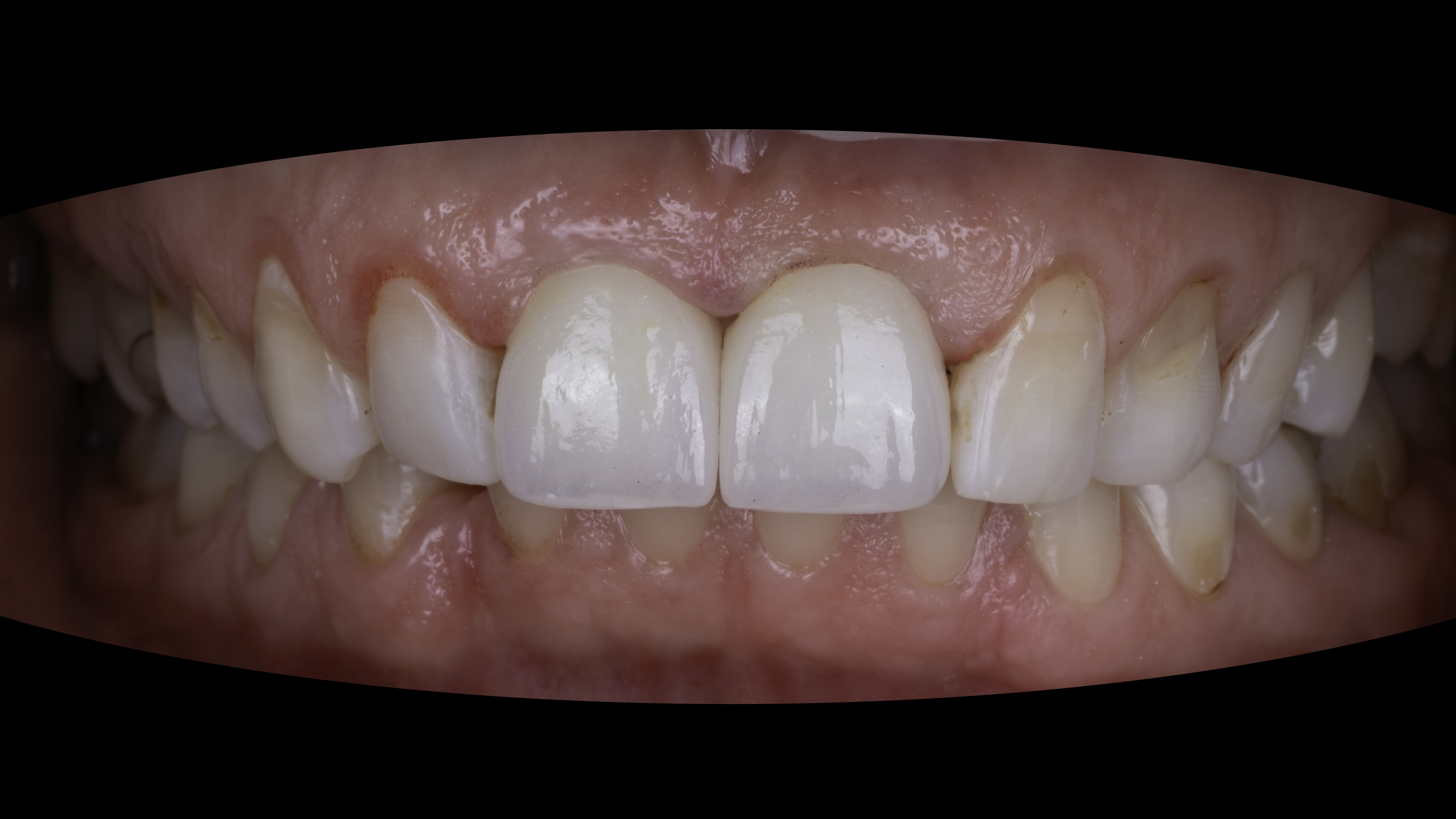 Retracted view — Full-arch implant before and after, Dark, aging front crowns renewed with implant restorations, Washington, DC — after treatment
