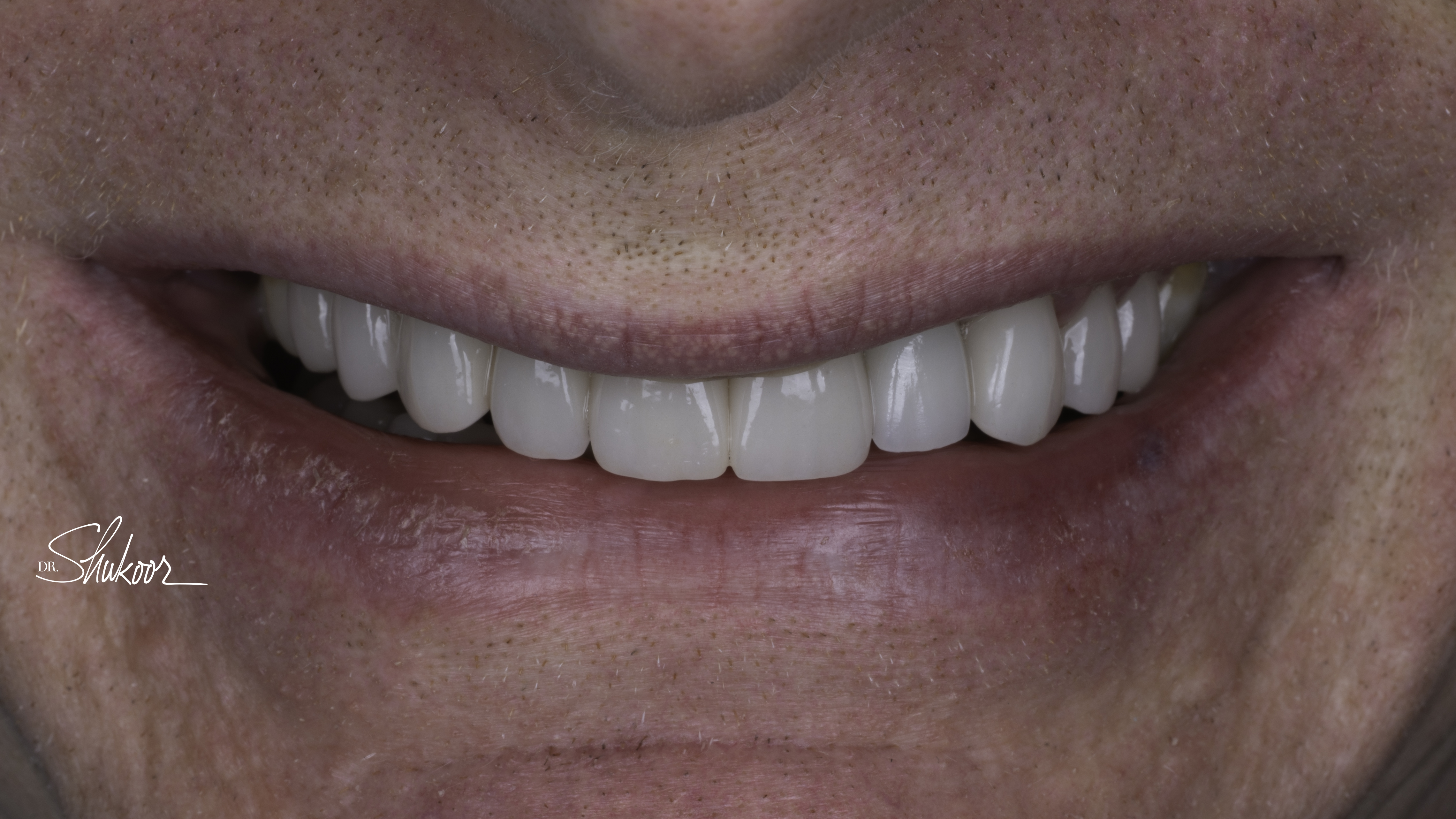 Close-up view — Smile makeover before and after, Damaged and discolored teeth renewed with full-mouth rehabilitation, Washington, DC — after treatment