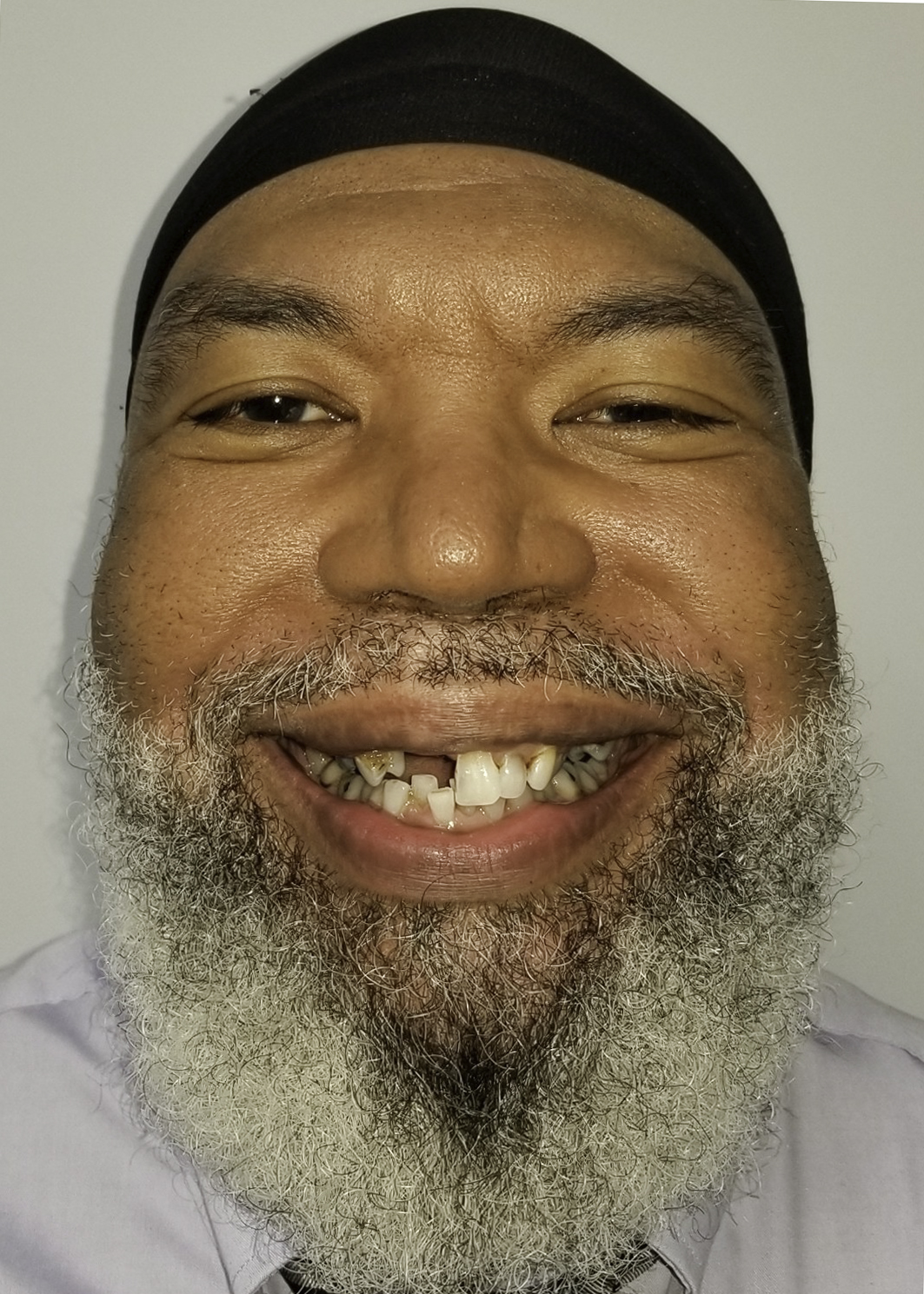 Full-arch implant before and after — Broken-down teeth rebuilt with full-arch implant restoration, treated by Dr. Kambez Shukoor in Washington, DC — before treatment