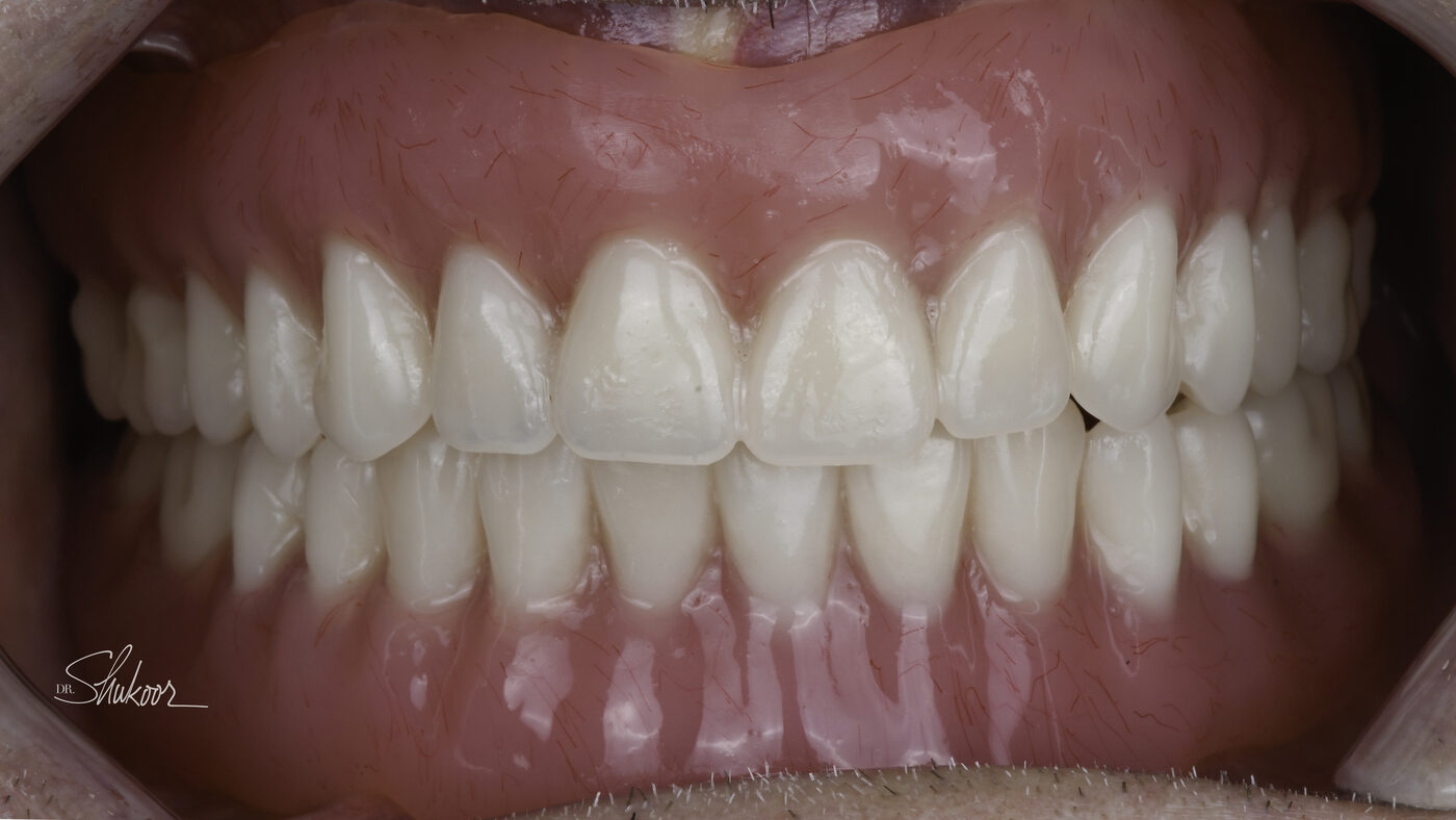 Dentures case — Full dentures restore a complete smile and comfortable bite, treated by Dr. Kambez Shukoor in Washington, DC — after treatment