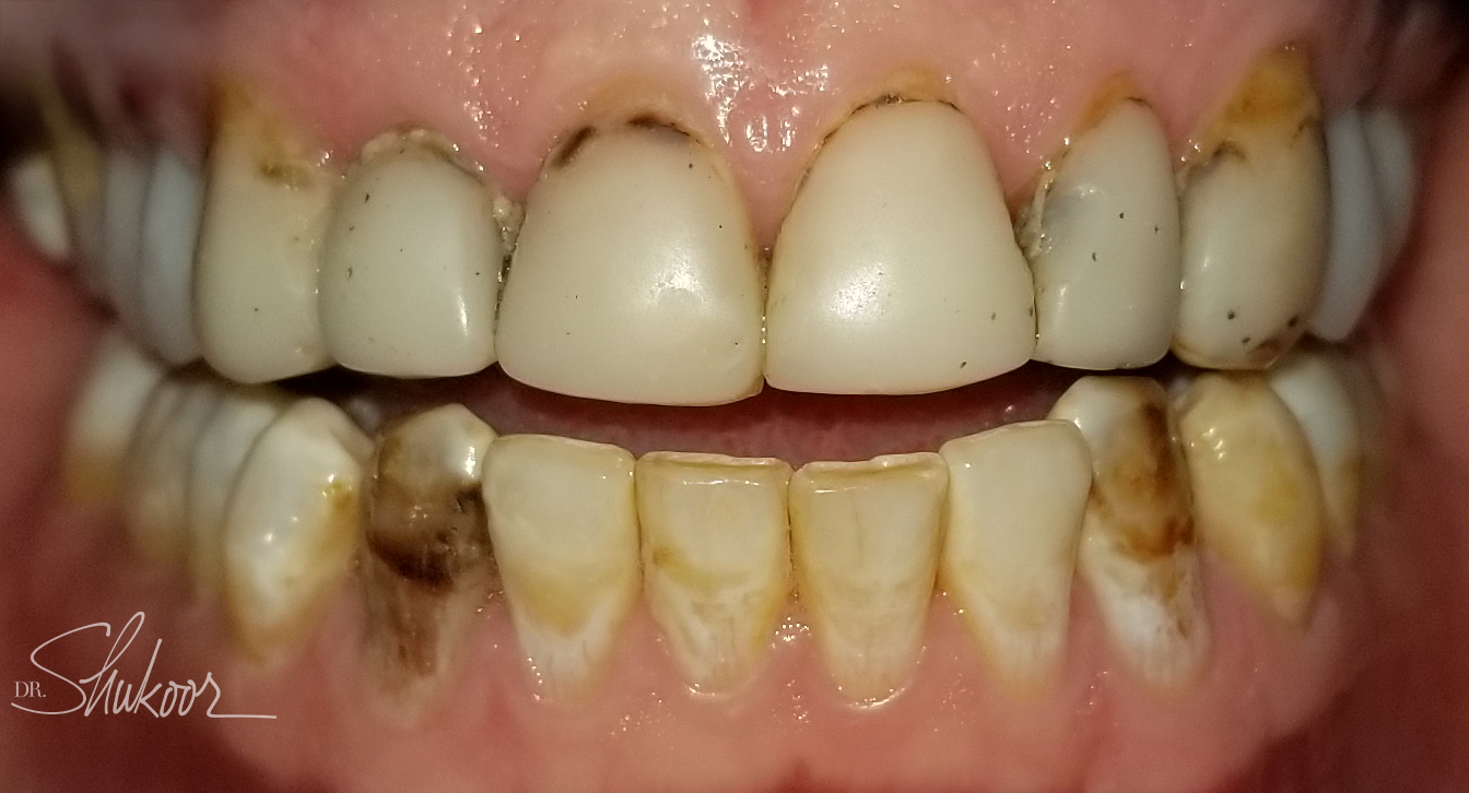 Smile makeover before and after — Smile makeover brightens and evens worn front teeth, treated by Dr. Kambez Shukoor in Washington, DC — before treatment