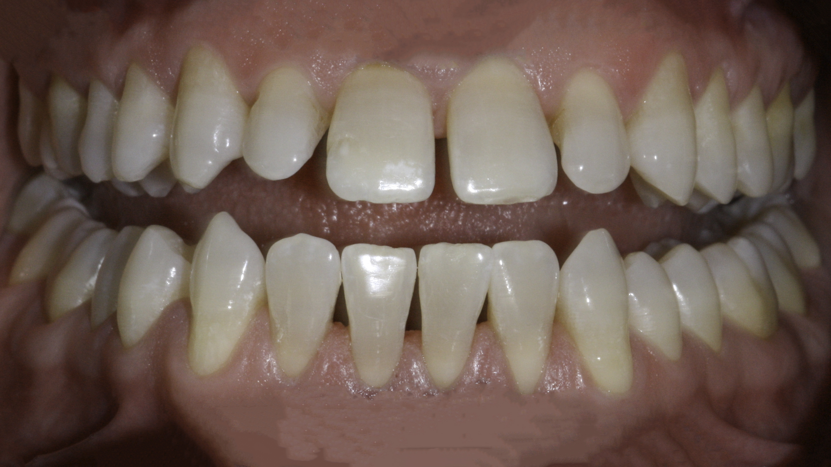 Close-up view — porcelain veneers before and after, Narrow, Spaced Teeth Reshaped With a Full Veneer Smile, Washington, DC — before treatment