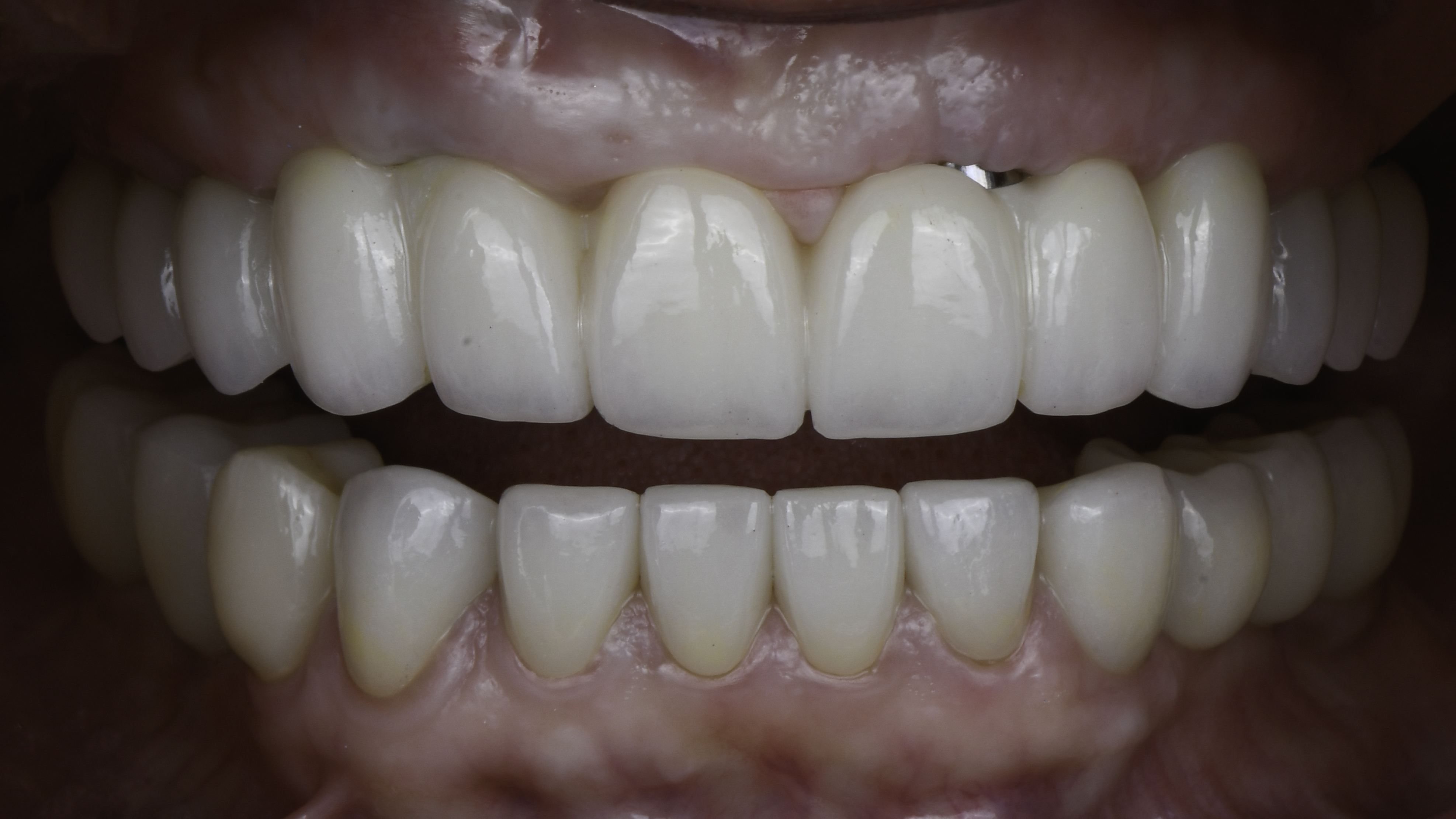 Retracted view — Single tooth implant before and after, Missing tooth replaced with a single dental implant and crown, Washington, DC — after treatment