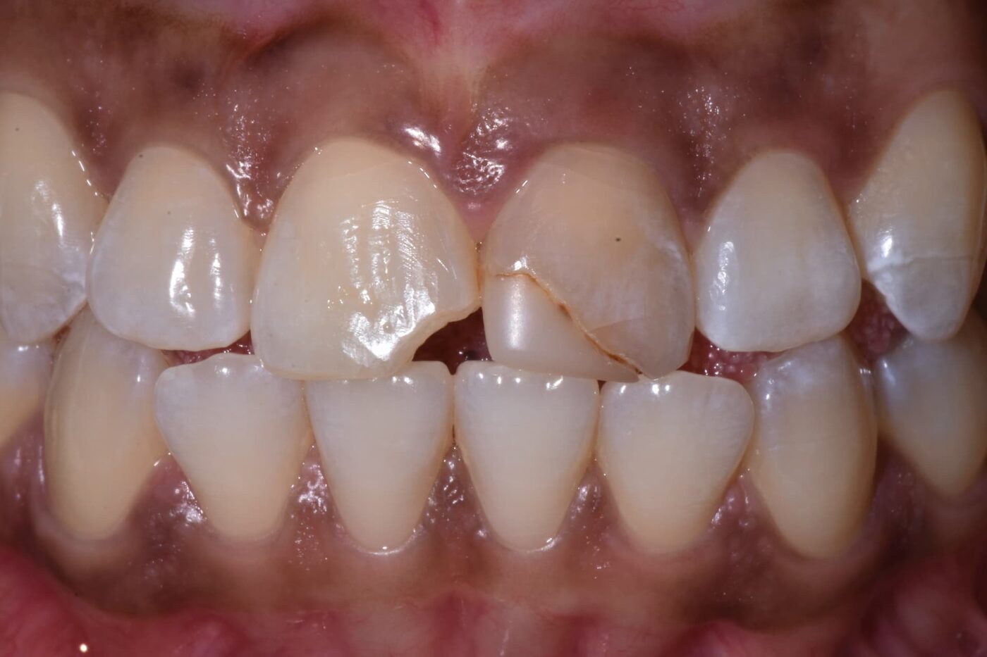Dental Bonding case — Chipped and worn upper front teeth rebuilt with composite bonding, treated by Dr. Kambez Shukoor in Washington, DC — before treatment