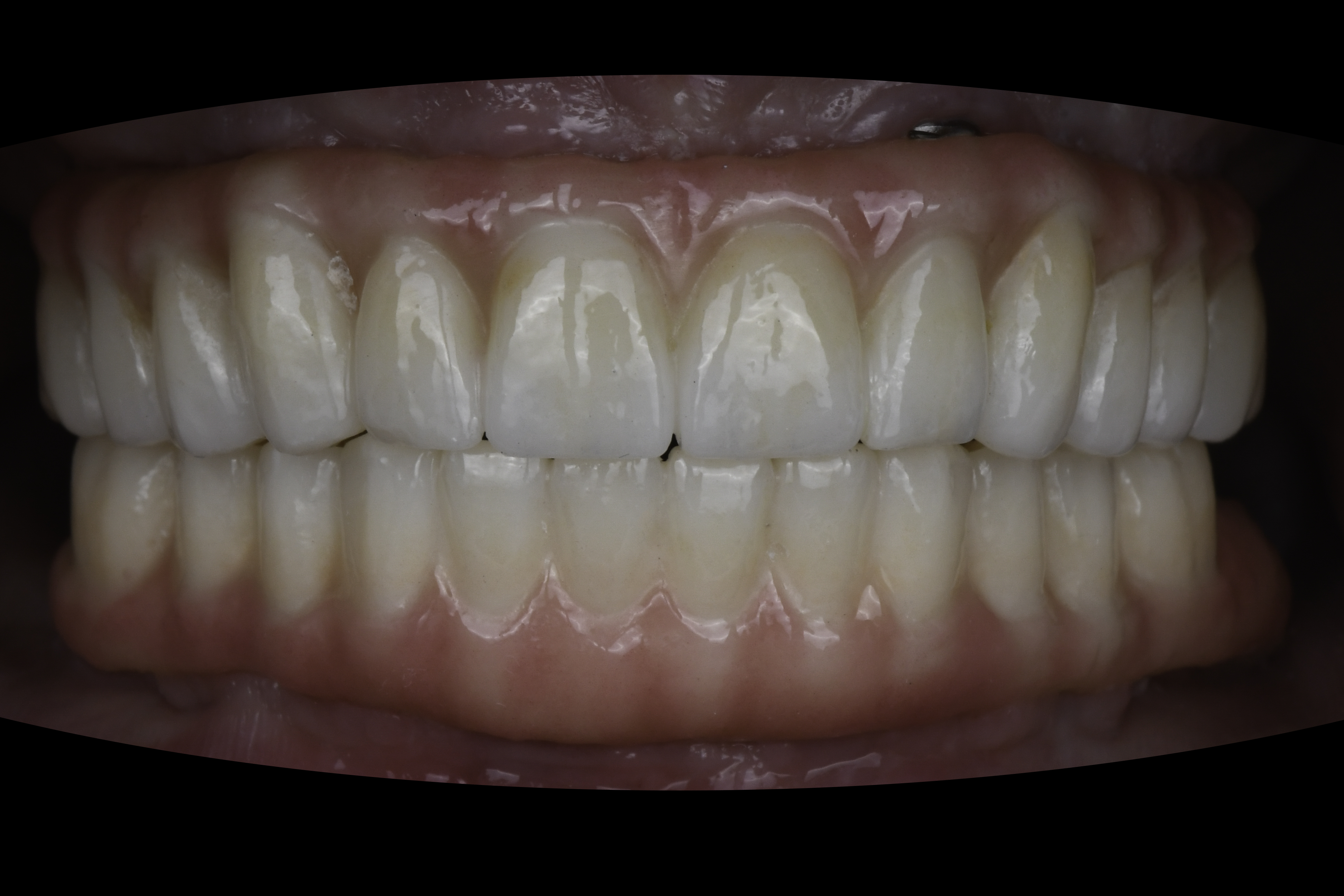 Smile view — Full-arch implant before and after, Complete upper and lower reconstruction on dental implants, Washington, DC — after treatment