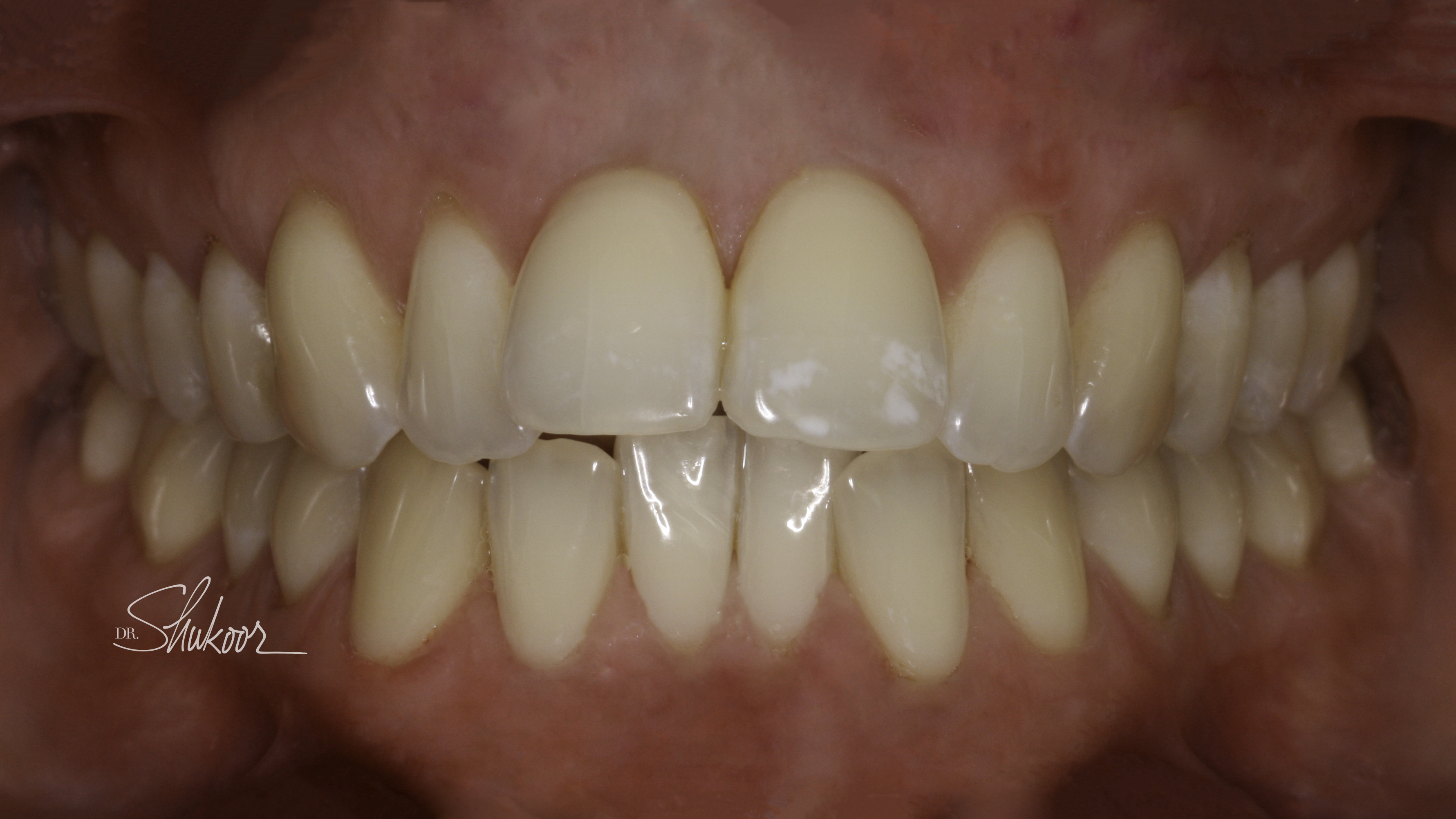 Clear aligners before and after — Worn, uneven incisal edges realigned with clear aligners, treated by Dr. Kambez Shukoor in Washington, DC — before treatment