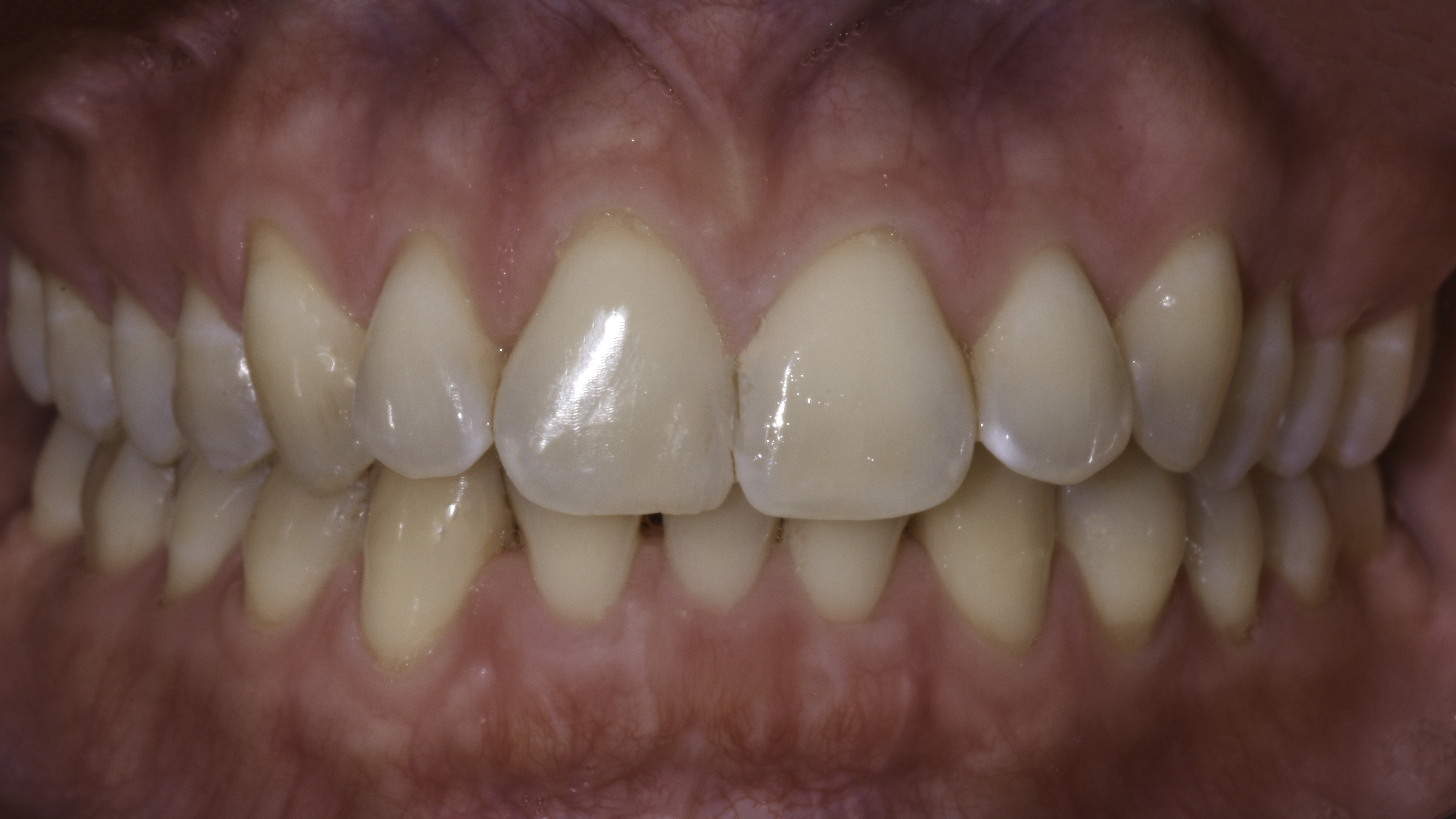 Clear aligners before and after, retracted view — Overlapping front teeth straightened with clear aligner therapy, treated by Dr. Kambez Shukoor in Washington, DC — before treatment