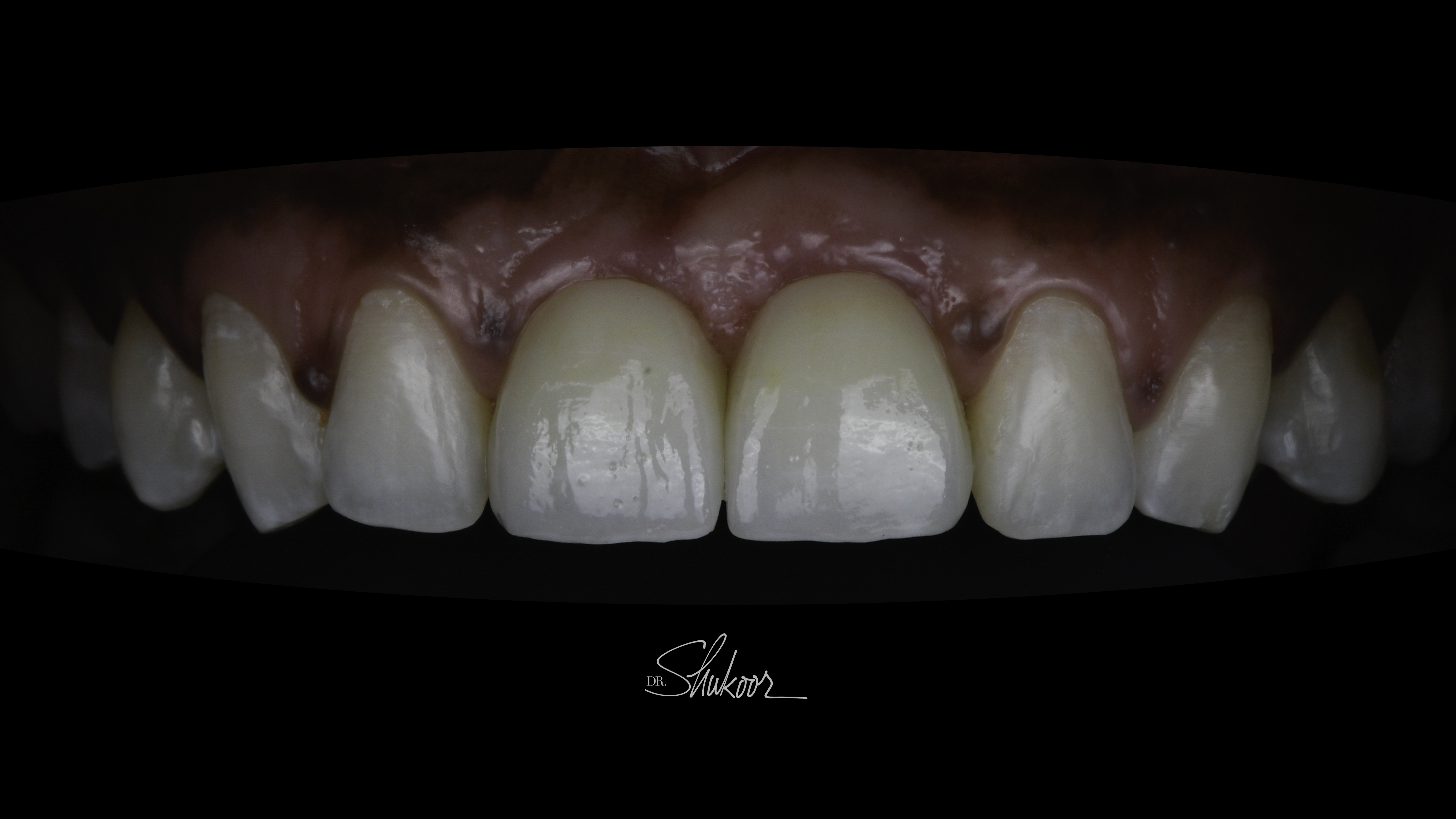 Close-up view — Full-arch implant before and after, Worn, discolored front teeth restored with implant crowns, Washington, DC — after treatment