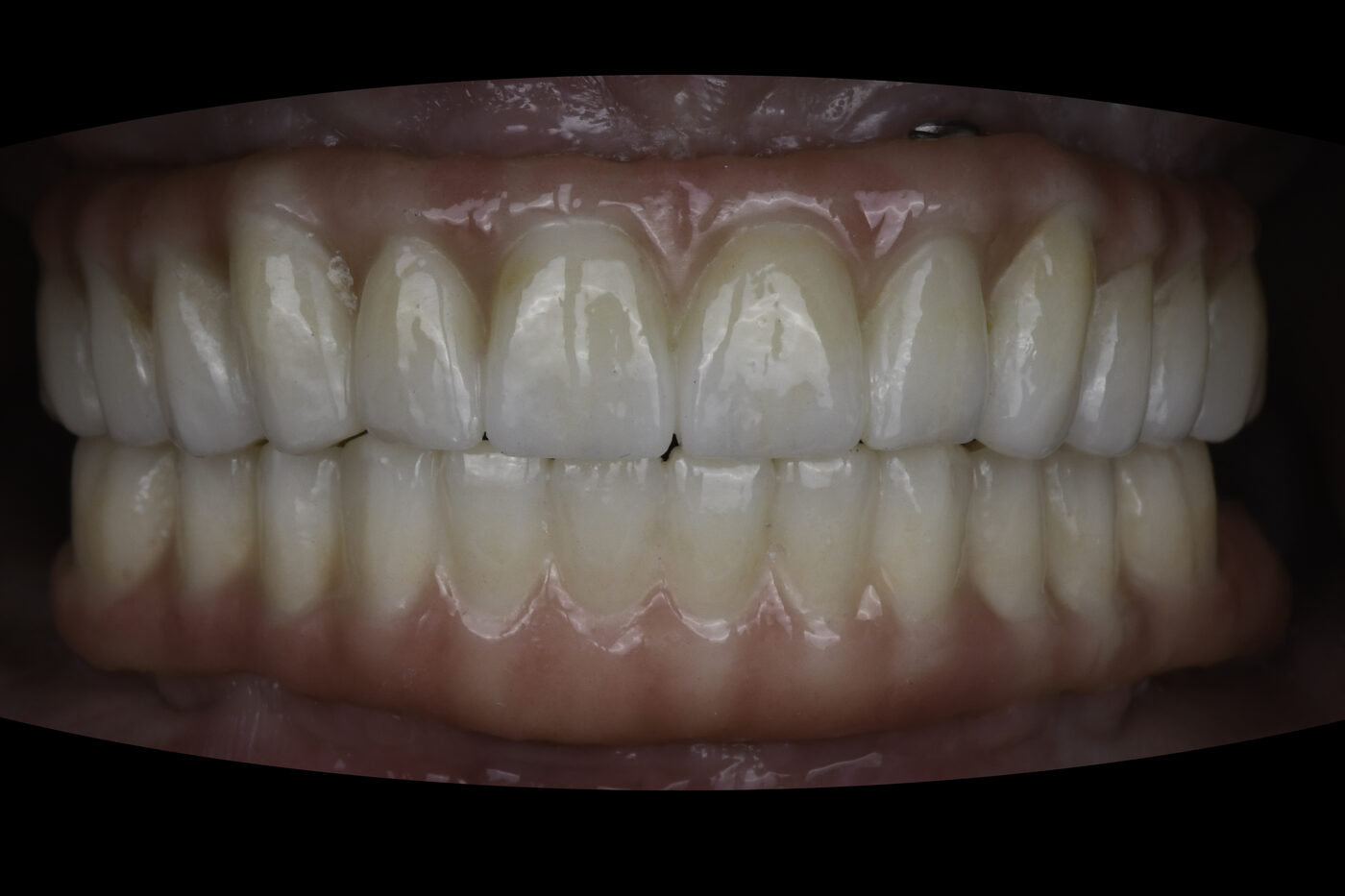 Full-Arch Implants case — Complete upper and lower reconstruction on dental implants, treated by Dr. Kambez Shukoor in Washington, DC — after treatment