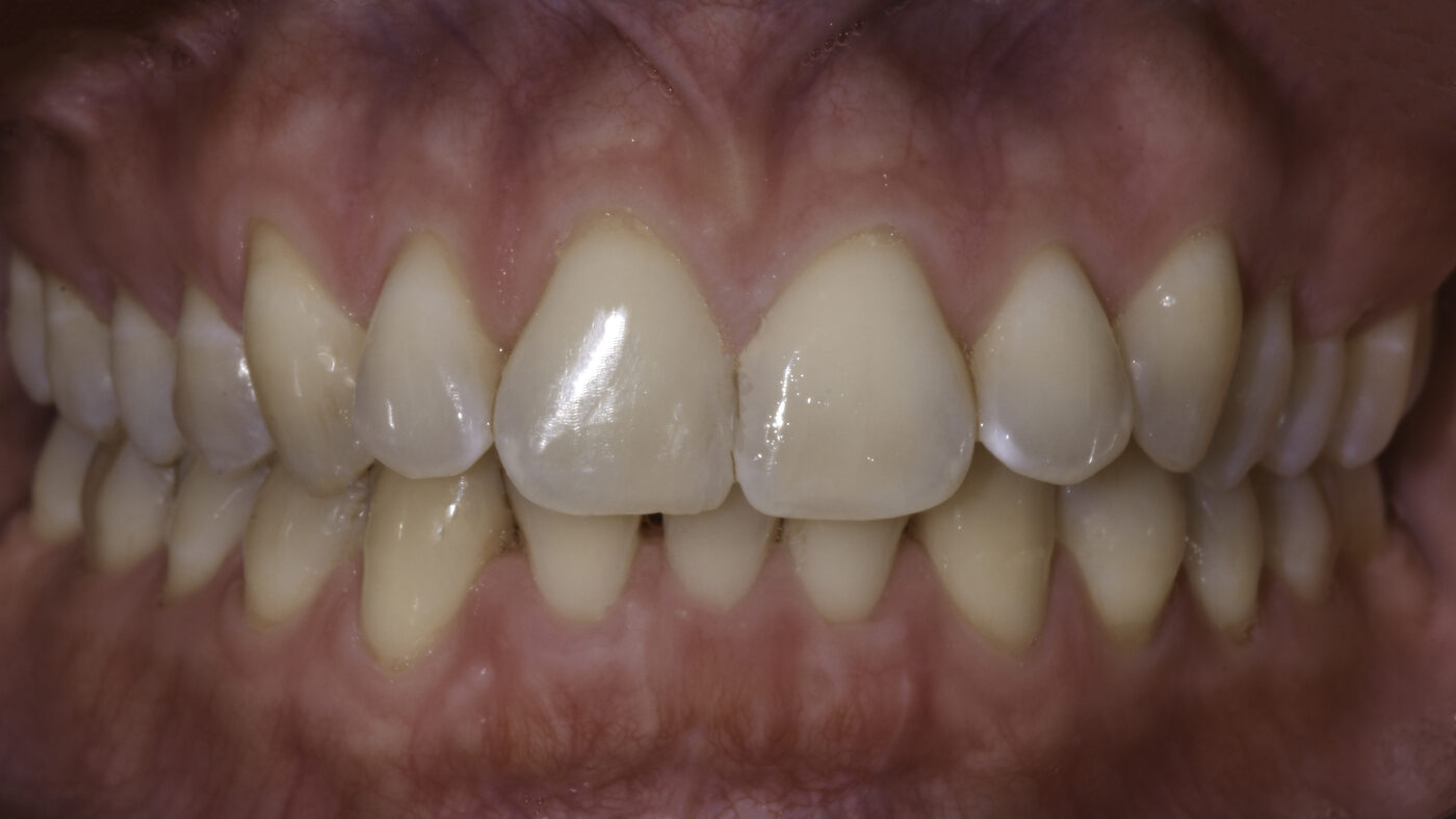 Clear Aligners case — Overlapping front teeth straightened with clear aligner therapy, treated by Dr. Kambez Shukoor in Washington, DC — before treatment