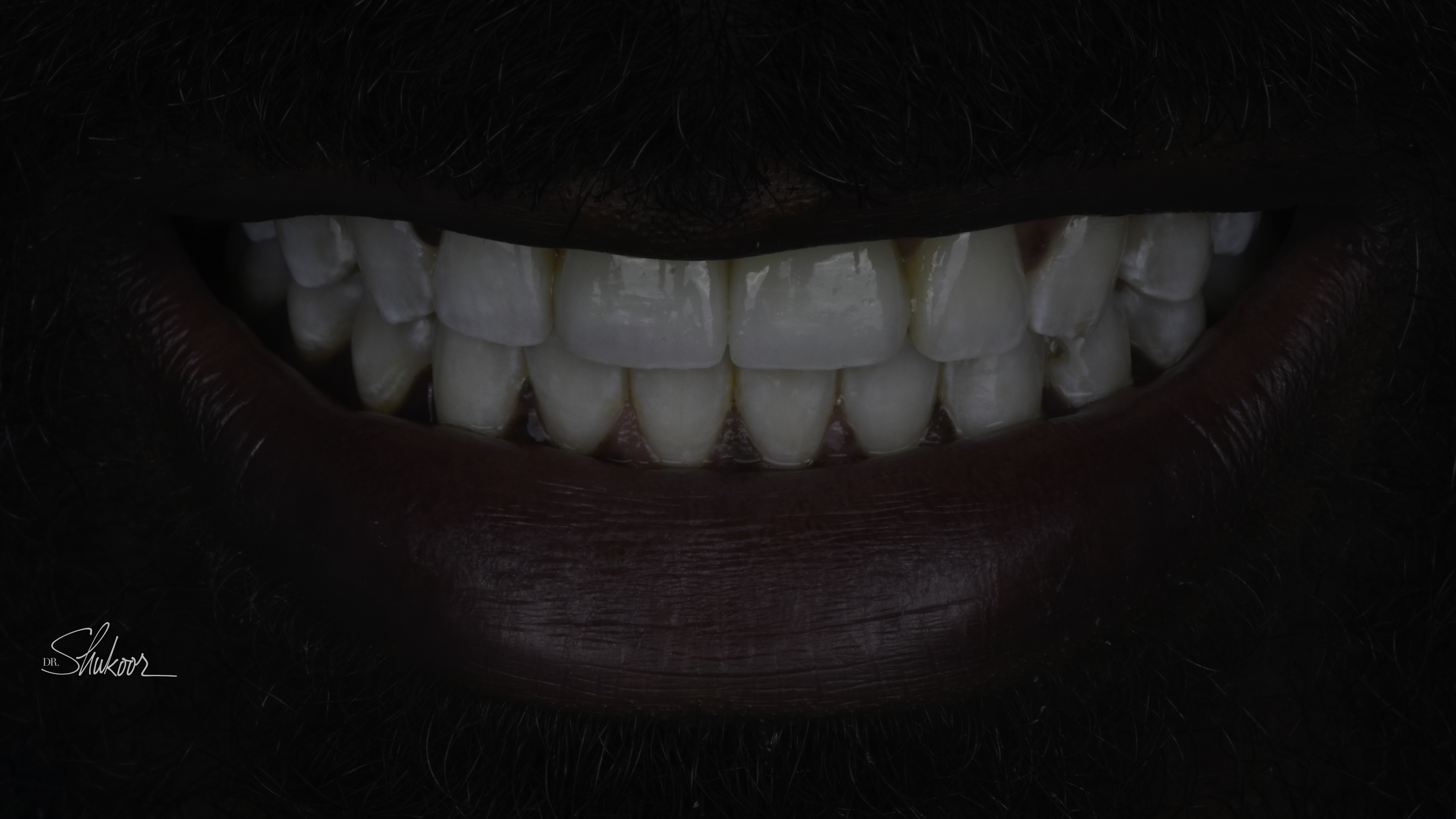 Full-arch implant before and after — Worn, discolored front teeth restored with implant crowns, treated by Dr. Kambez Shukoor in Washington, DC — after treatment