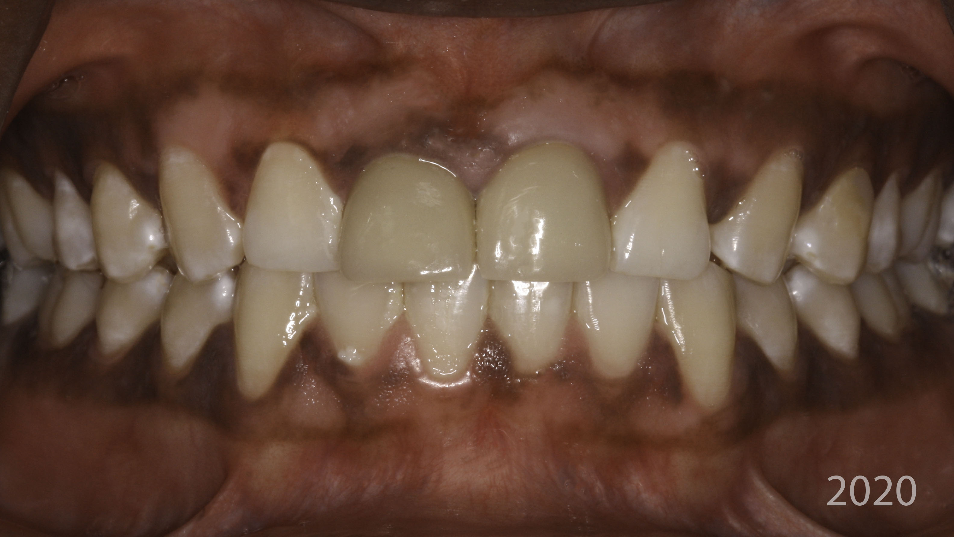 Retracted view — Full-arch implant before and after, Worn, discolored front teeth restored with implant crowns, Washington, DC — before treatment