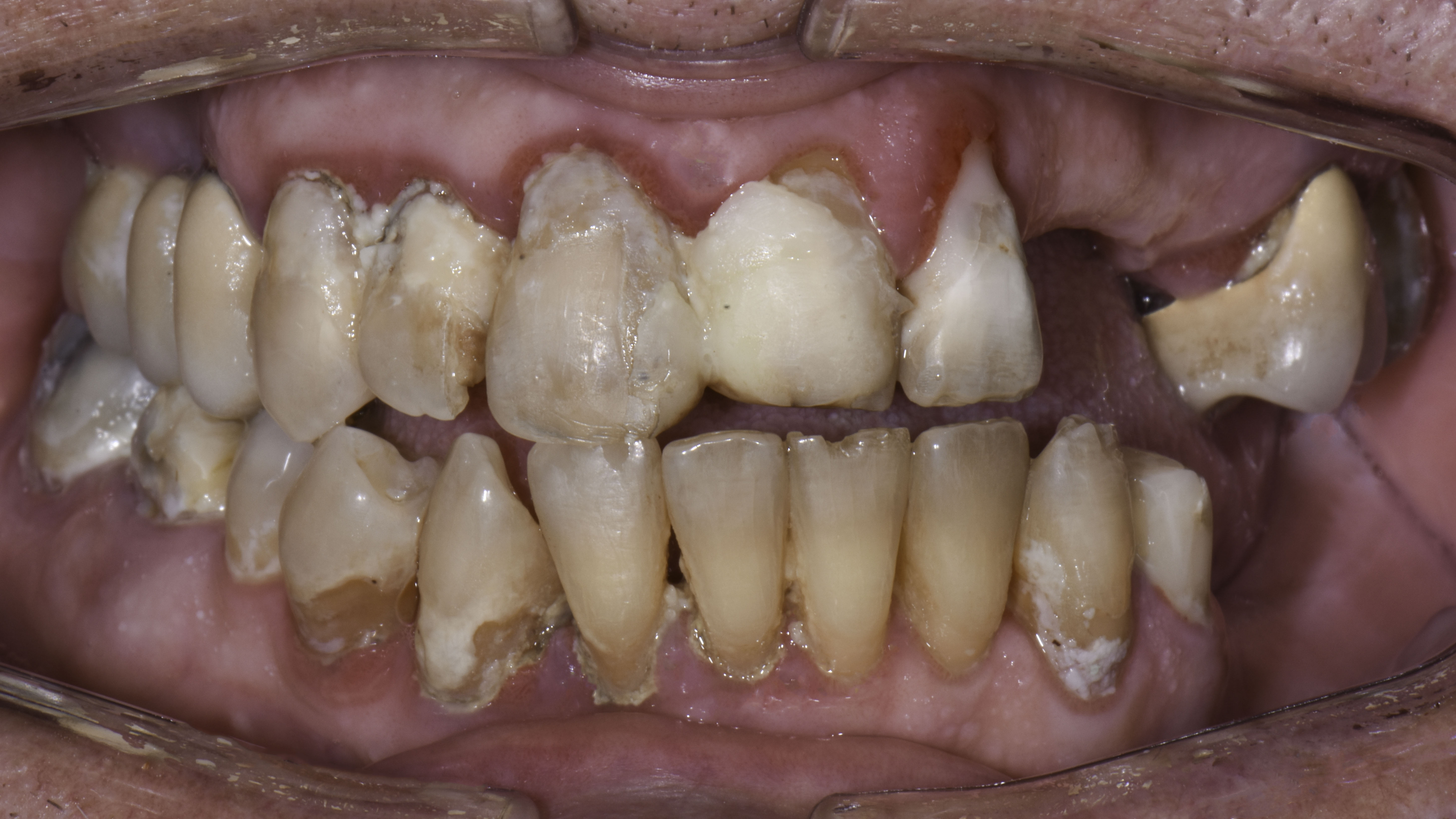 Retracted view — Full-arch implant before and after, Advanced periodontal breakdown treated with full-arch implants, Washington, DC — before treatment