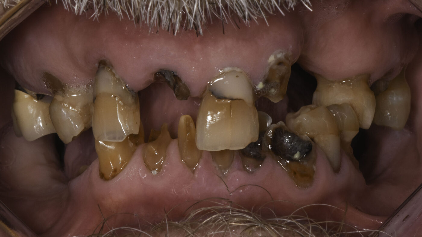 Full-Arch Implants case — Complete upper and lower reconstruction on dental implants, treated by Dr. Kambez Shukoor in Washington, DC — before treatment