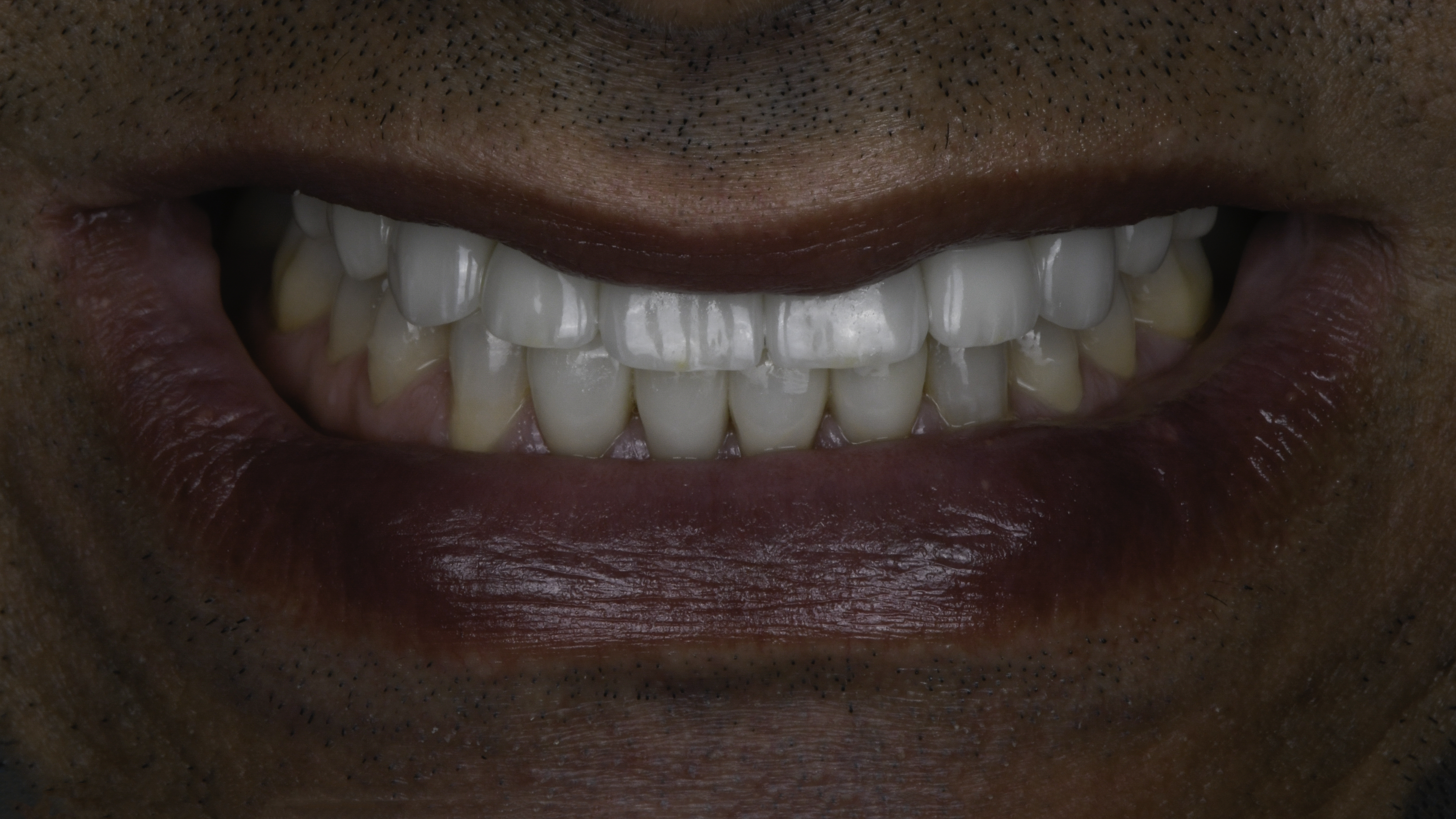 Close-up view — porcelain veneers before and after, Narrow, Spaced Teeth Reshaped With a Full Veneer Smile, Washington, DC — after treatment