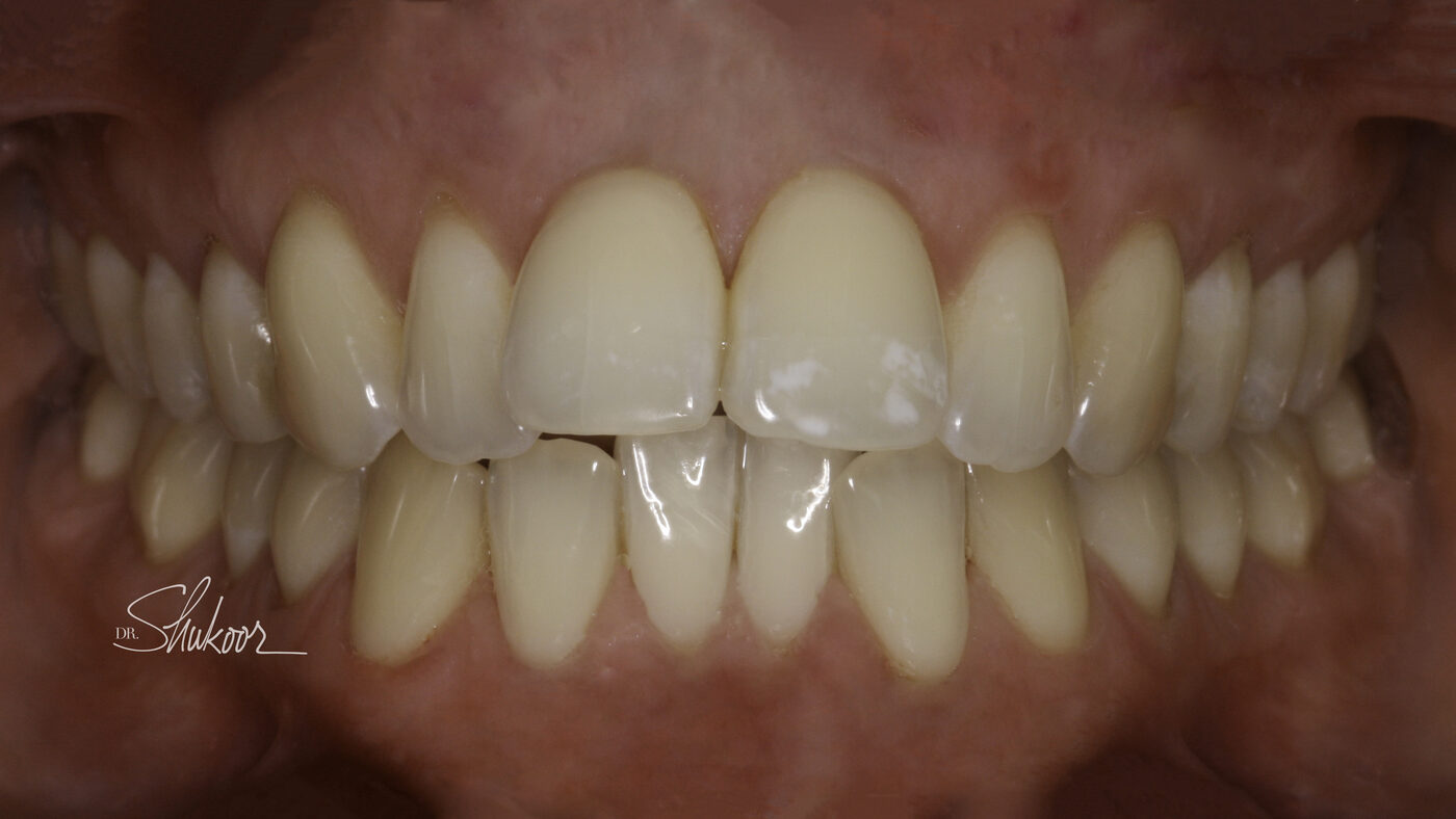 Clear Aligners case — Worn, uneven incisal edges realigned with clear aligners, treated by Dr. Kambez Shukoor in Washington, DC — before treatment