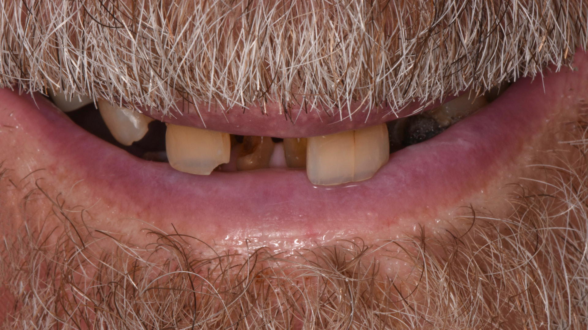Retracted view — Full-arch implant before and after, Complete upper and lower reconstruction on dental implants, Washington, DC — before treatment