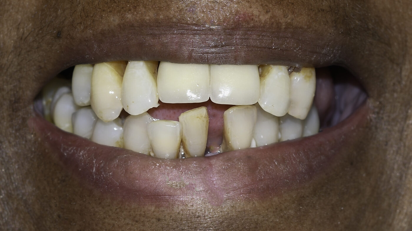 Full-Arch Implants case — Failing upper teeth replaced with a fixed implant-supported arch, treated by Dr. Kambez Shukoor in Washington, DC — before treatment