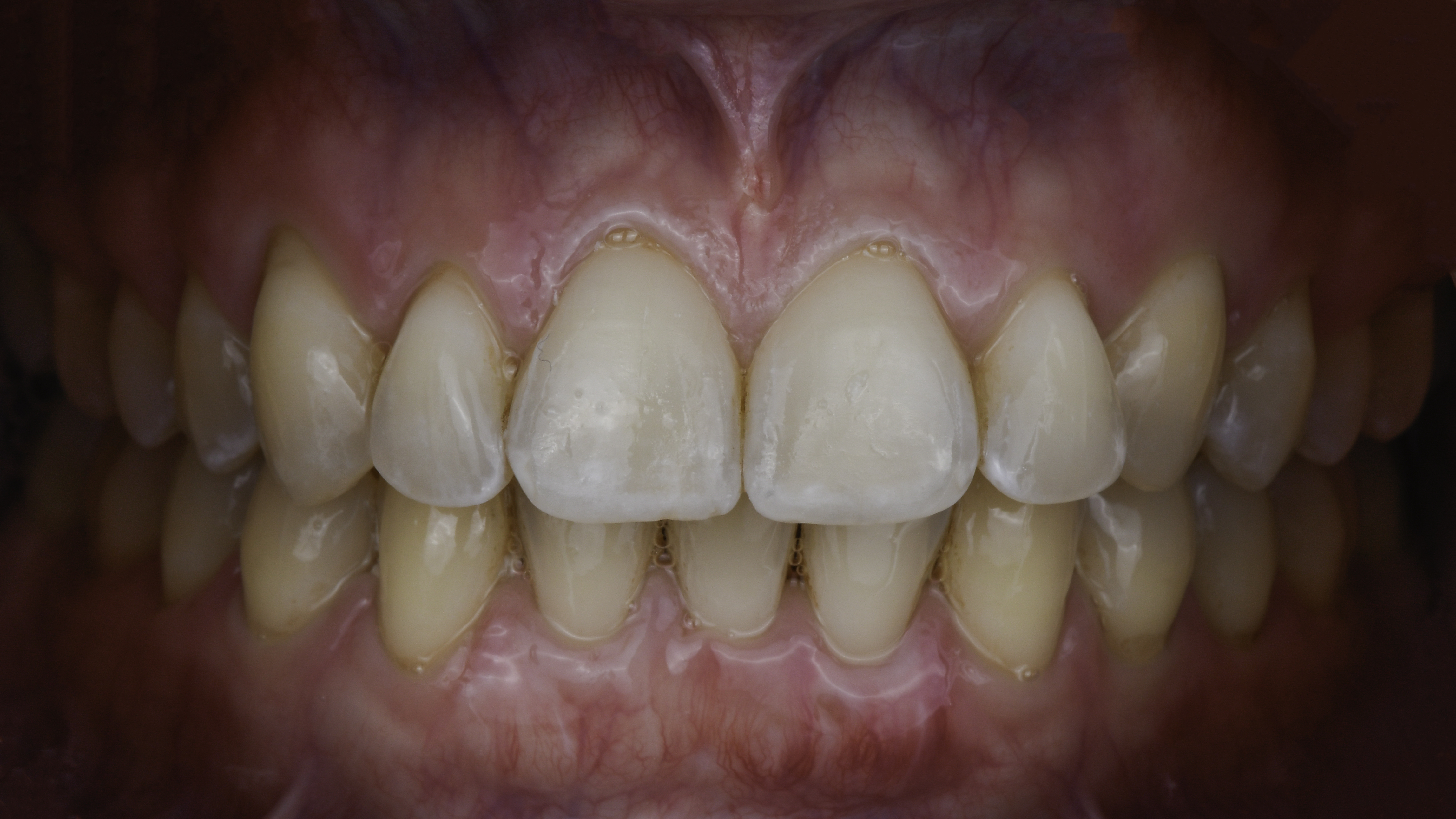 Clear aligners before and after, retracted view — Overlapping front teeth straightened with clear aligner therapy, treated by Dr. Kambez Shukoor in Washington, DC — after treatment