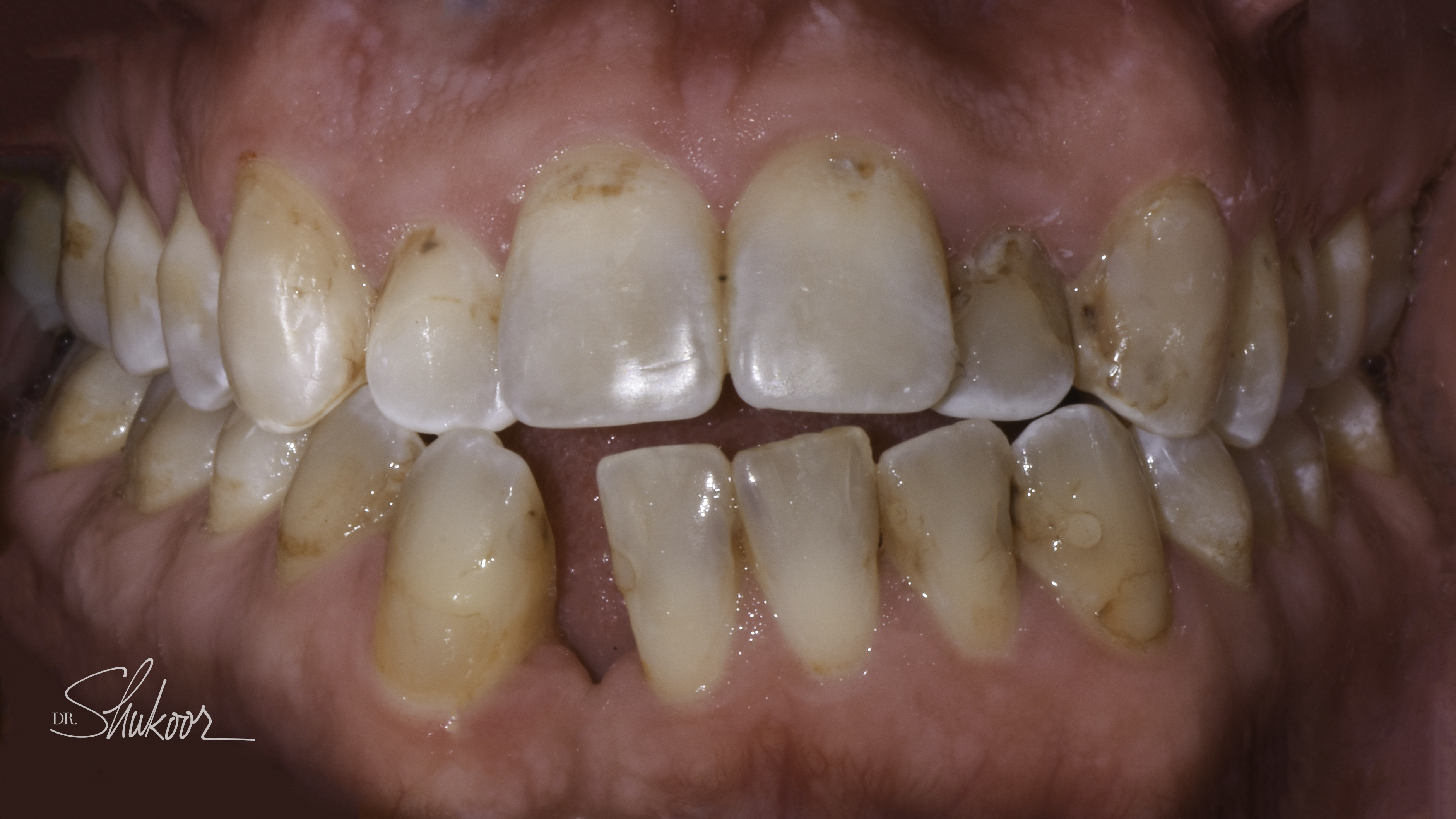 Smile makeover before and after — Smile makeover restores symmetry and a healthy shade, treated by Dr. Kambez Shukoor in Washington, DC — before treatment