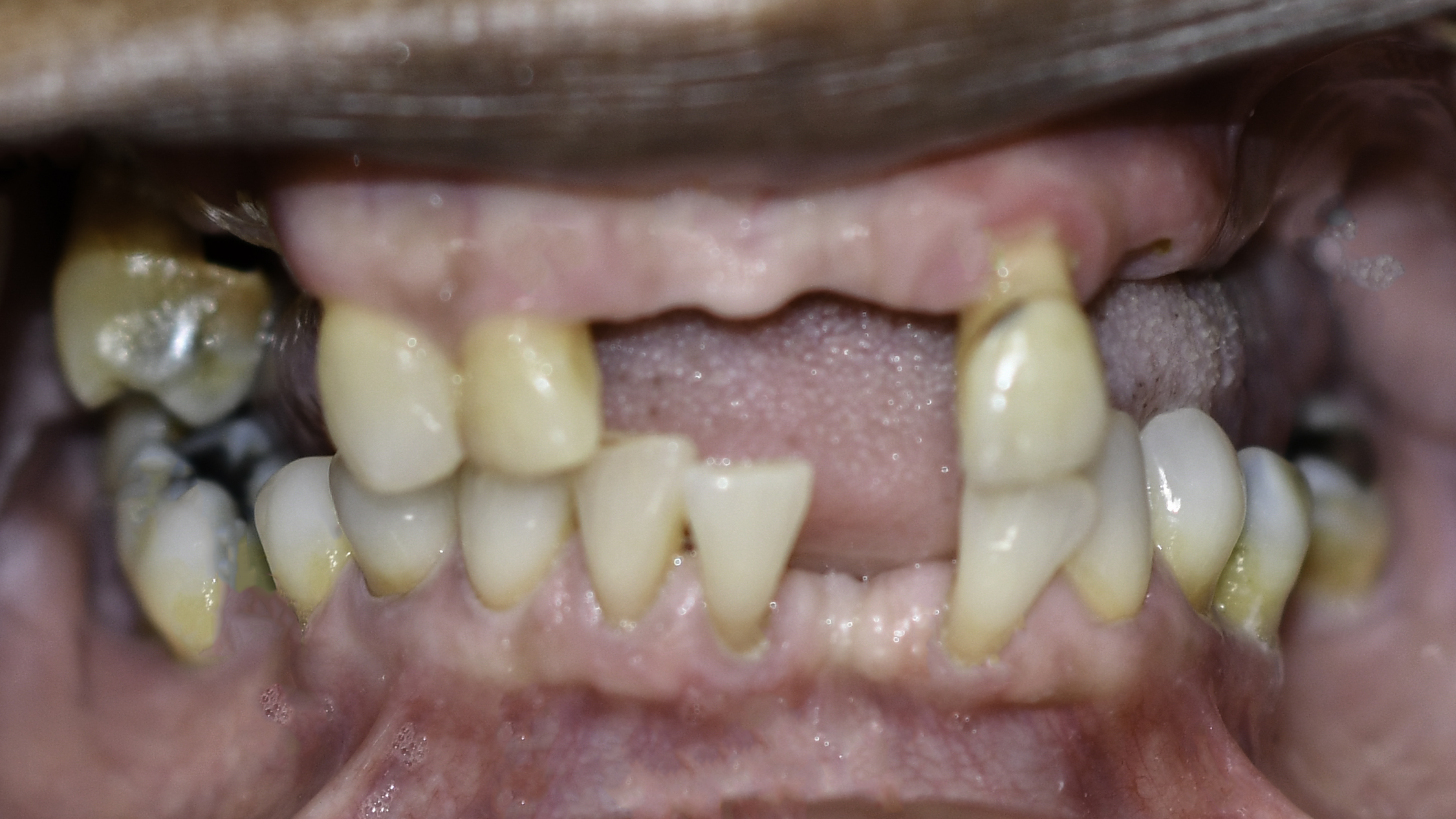 Retracted view — Full-arch implant before and after, Failing dentition replaced with fixed full-arch implant teeth, Washington, DC — before treatment