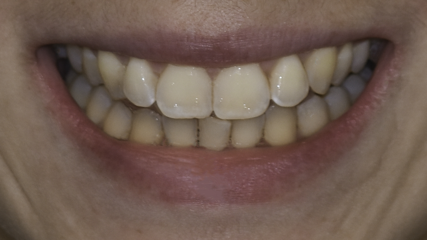 Clear aligners before and after — Overlapping front teeth straightened with clear aligner therapy, treated by Dr. Kambez Shukoor in Washington, DC — before treatment