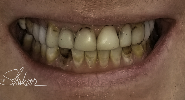 Smile makeover before and after — Smile makeover brightens and evens worn front teeth, treated by Dr. Kambez Shukoor in Washington, DC — before treatment
