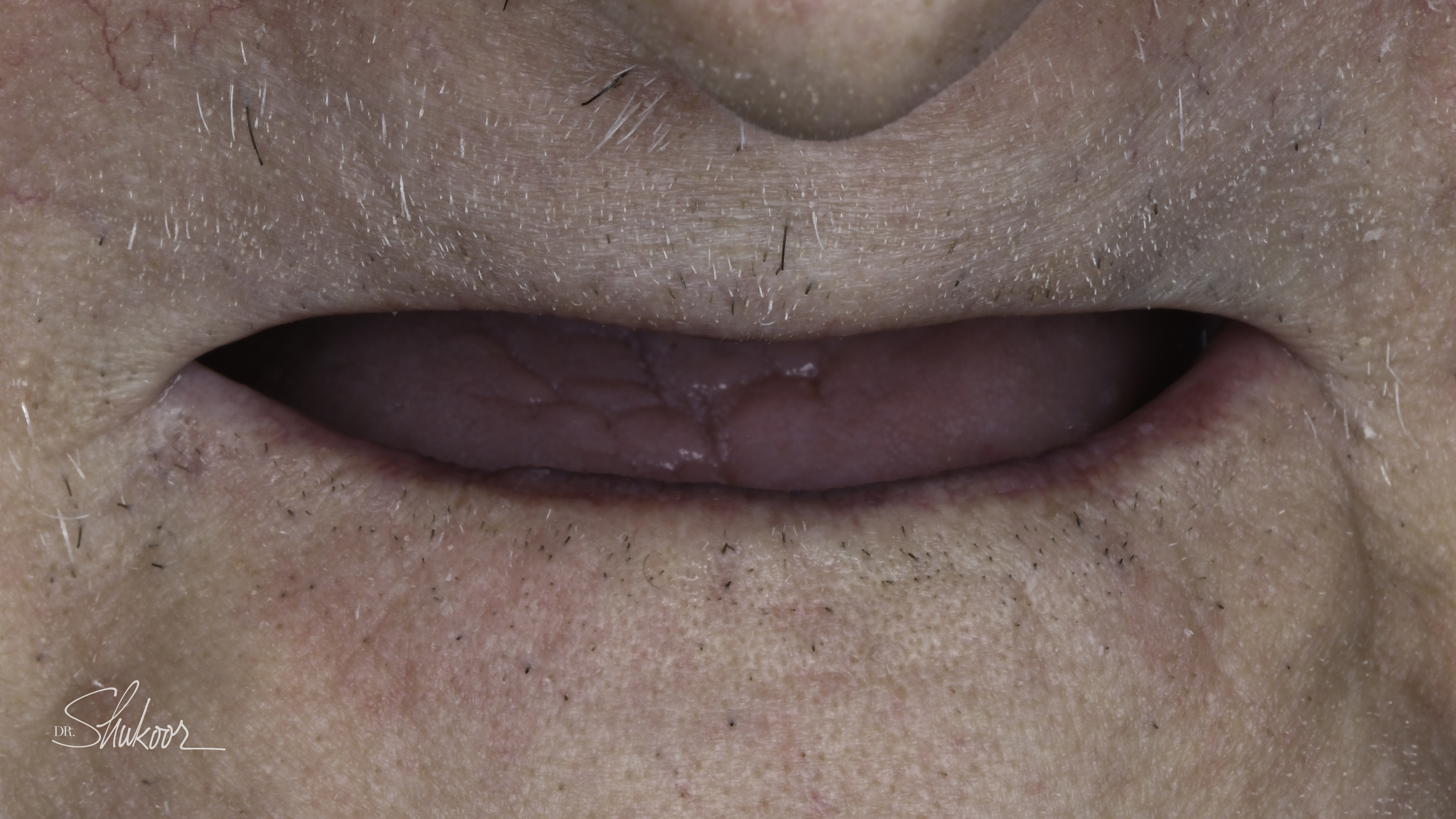 Dentures case — Full dentures restore a complete smile and comfortable bite, treated by Dr. Kambez Shukoor in Washington, DC — before treatment