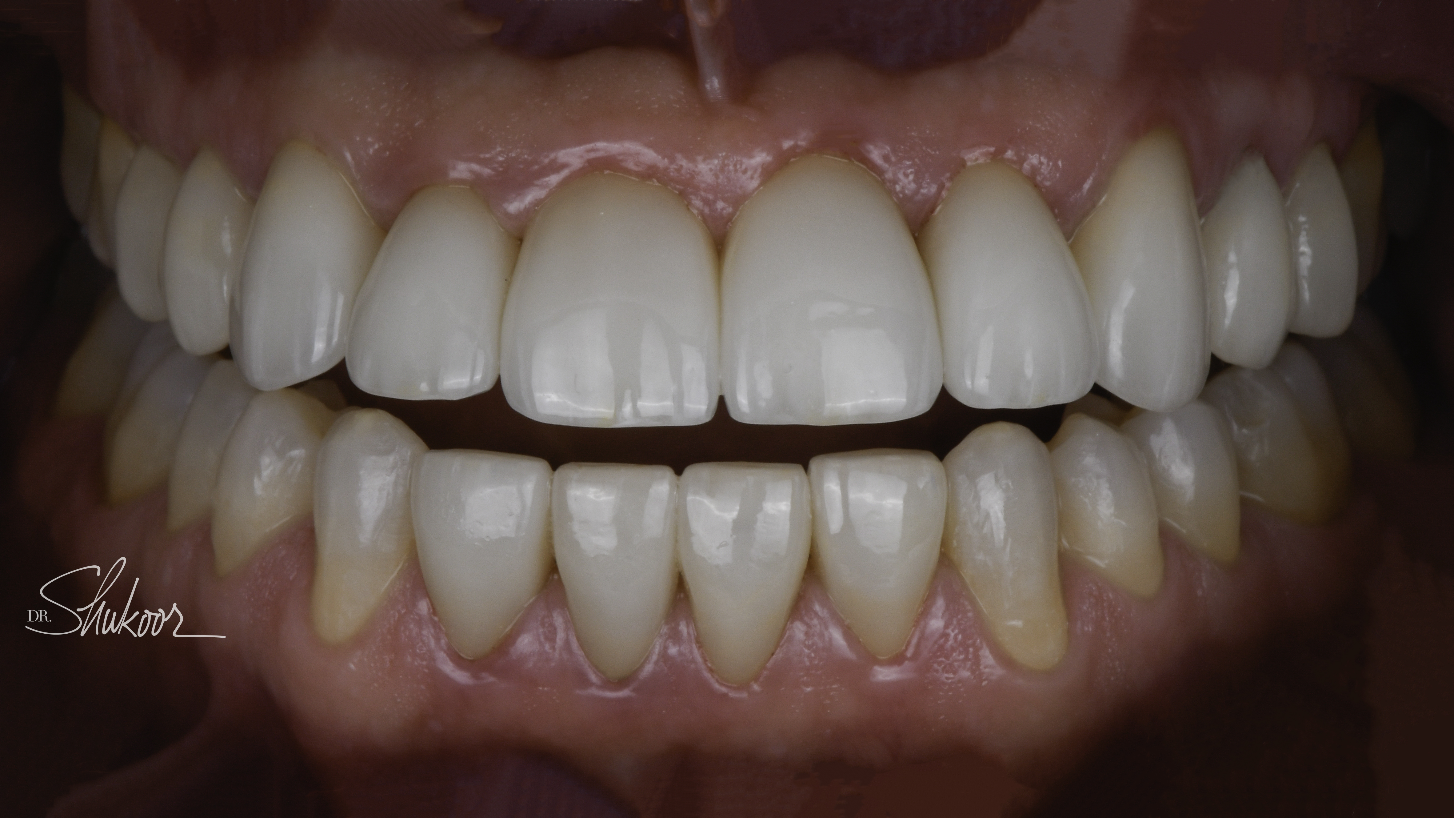 Porcelain veneers before and after — Narrow, Spaced Teeth Reshaped With a Full Veneer Smile, treated by Dr. Kambez Shukoor in Washington, DC — after treatment