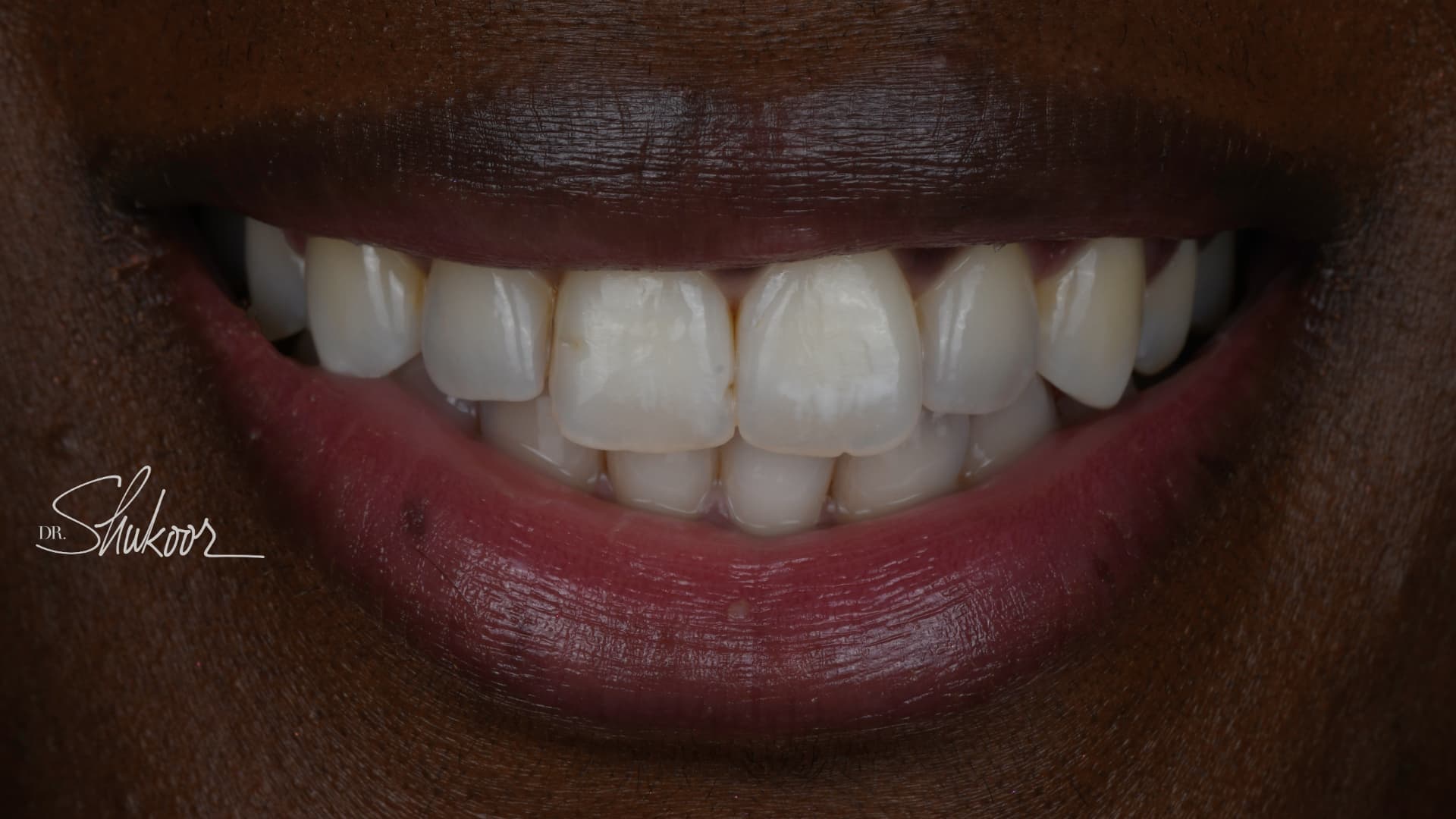 Clear aligners before and after — Crowded upper and lower front teeth aligned with clear aligners, treated by Dr. Kambez Shukoor in Washington, DC — after treatment