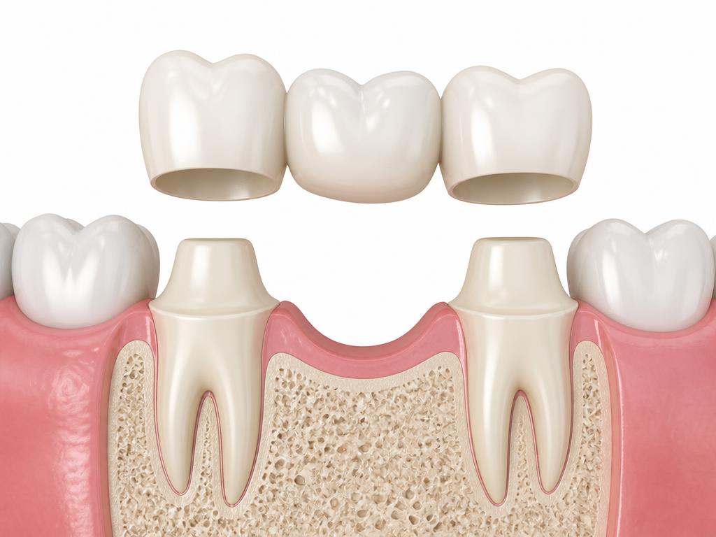 Illustration of a three-unit dental bridge above two prepared anchor teeth on either side of a missing lower tooth, with bone shown in cross-section