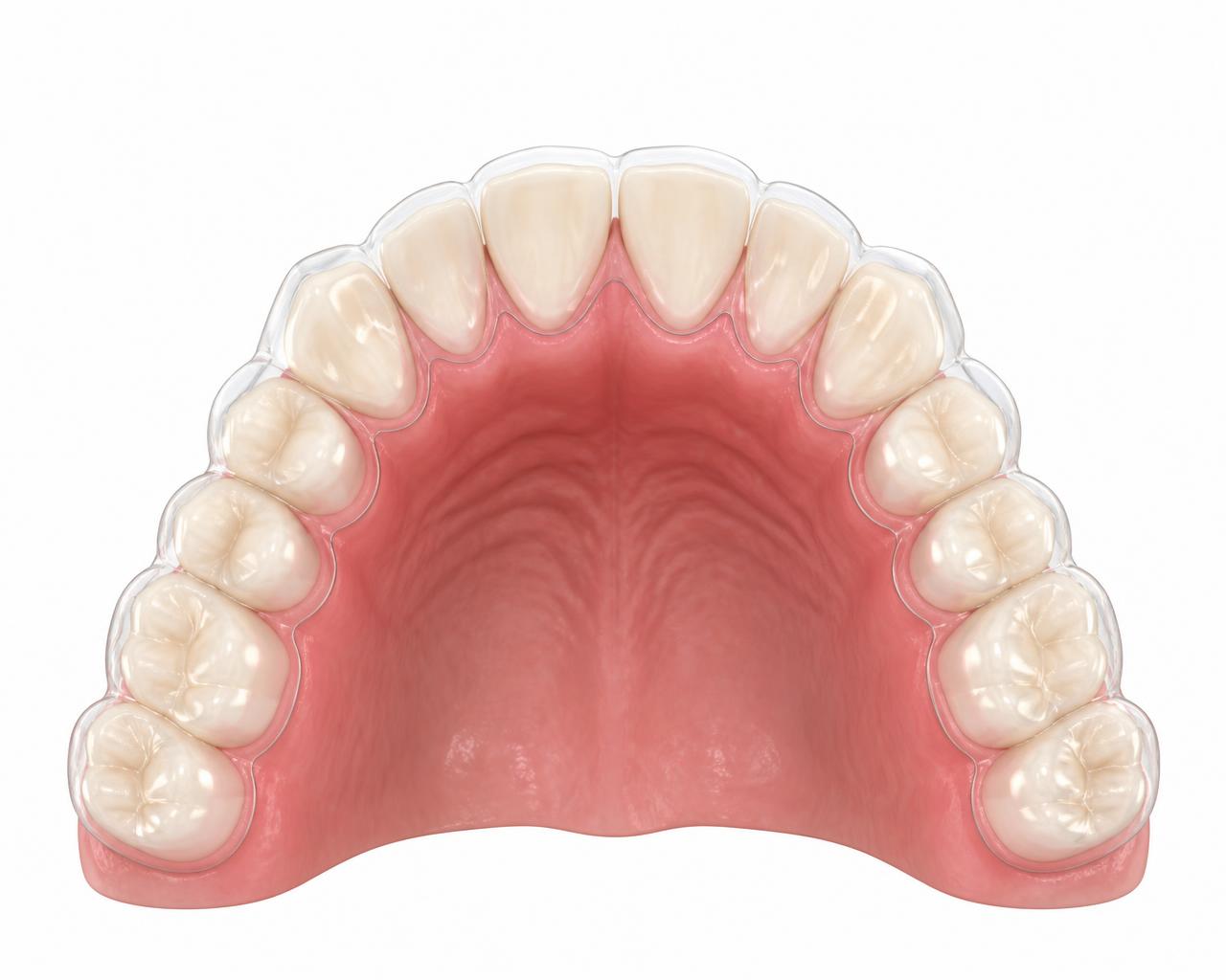 Illustration of a transparent clear aligner tray fitted over a full upper arch of natural teeth