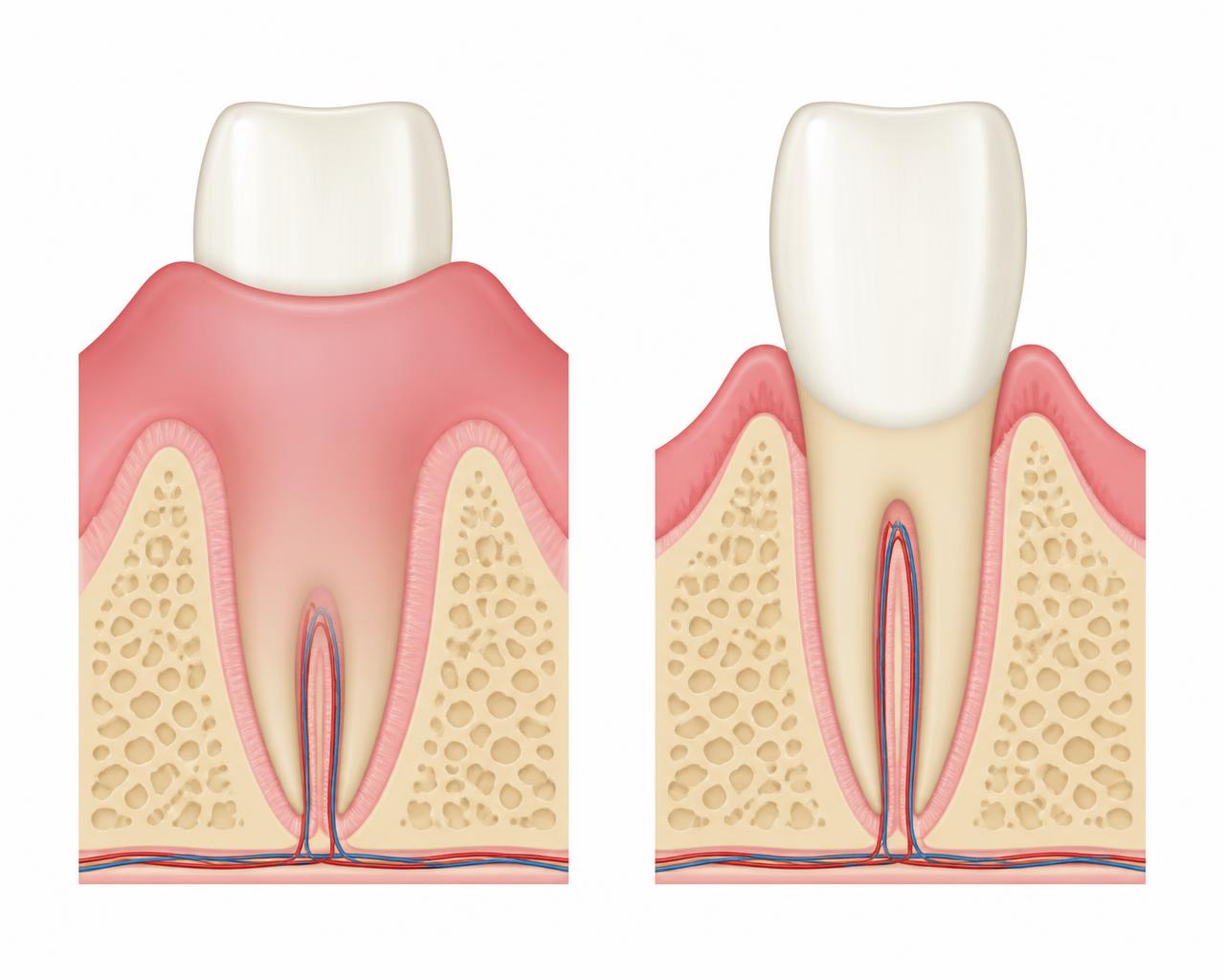 Cross-section illustration comparing a tooth with excess gum tissue covering most of its crown and the same tooth after crown lengthening, with the gum and bone recontoured to expose more tooth structure