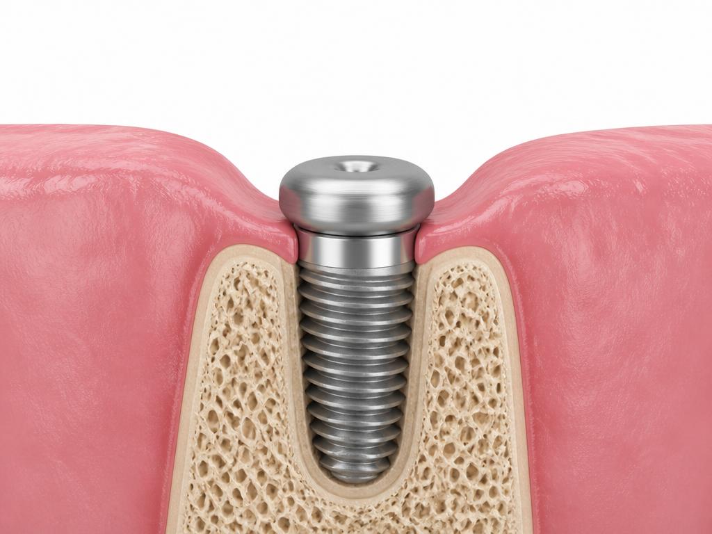 Illustration of a single titanium dental implant with a healing cap integrating in the jawbone before restoration