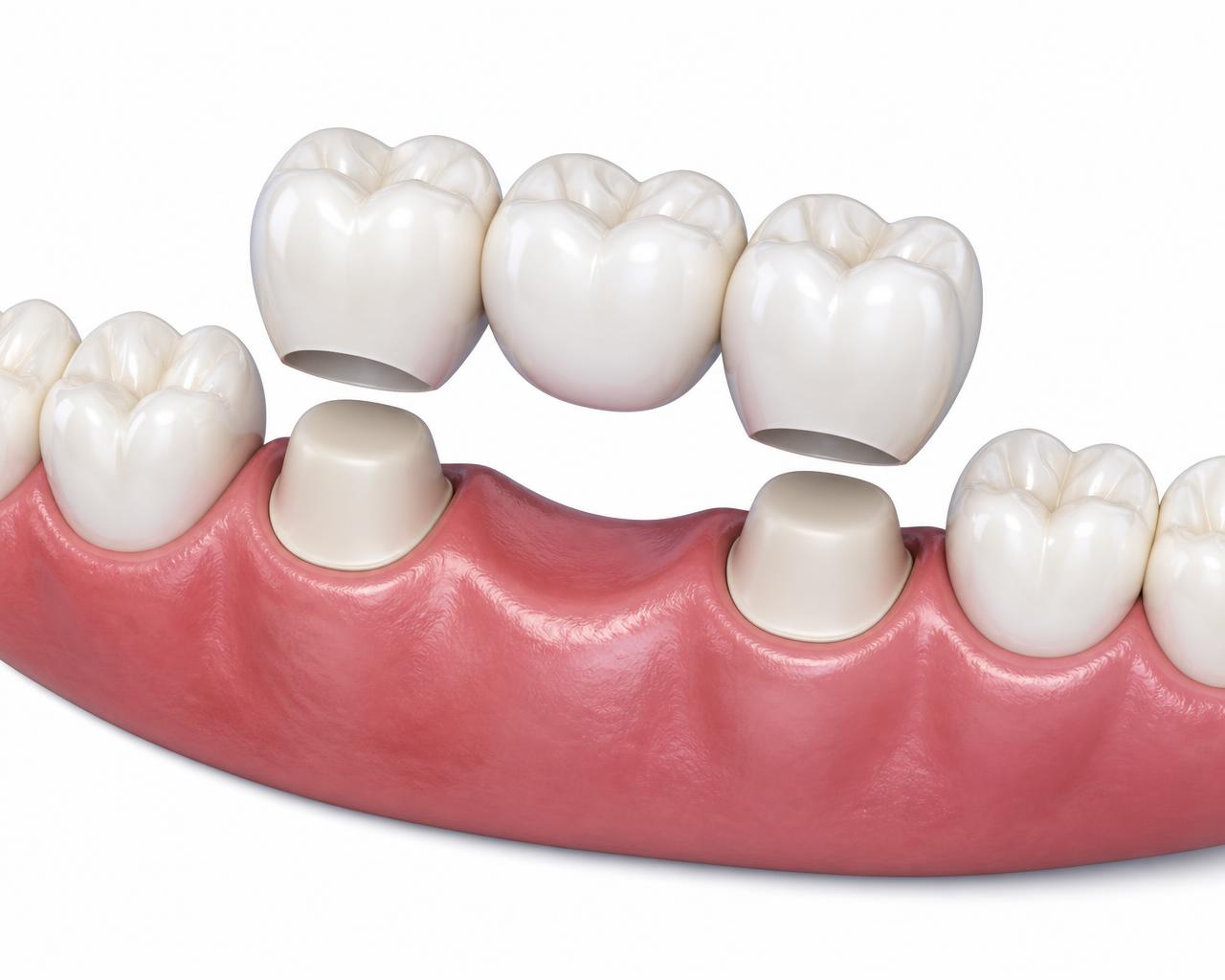 Illustration of a three-unit dental bridge being seated over two prepared anchor teeth on either side of a missing lower molar