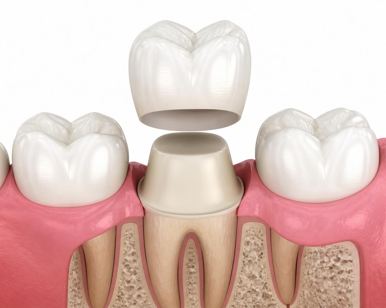 Illustration of a ceramic dental crown being seated over a prepared natural molar between two healthy teeth