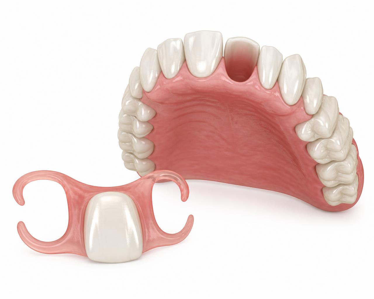Dental flipper — a thin pink acrylic temporary partial denture holding one white replacement front tooth, shown beside an upper arch with a gap where the tooth is missing