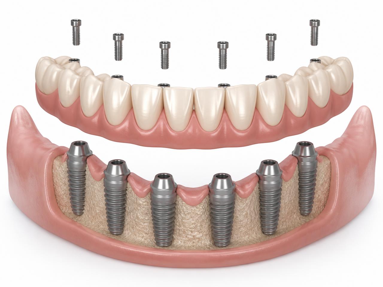 Illustration of a fixed full-arch implant prosthesis secured onto angled titanium implants in the lower jawbone